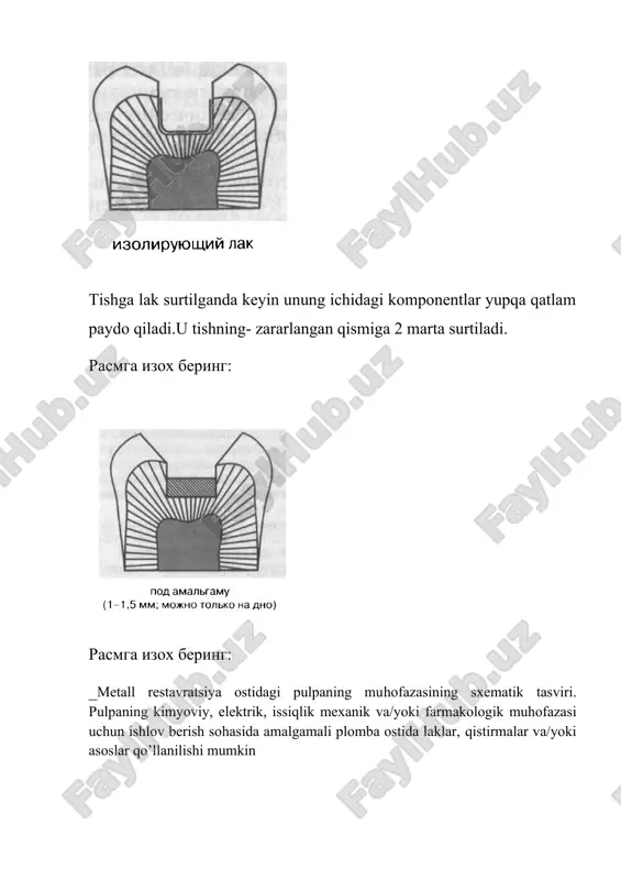 hi taglikka kiradi .odondotrop guruhiga kirib tayyor holda ishlab chiqariladi. вазифа №4 расмга изохберинг: расмга изох беринг: расмга изох беринг:amalgamali plombalar uchun qistirmalar va aoslarni qo’llashning sxematik tasviri ; ishlov berish sohasi chuqur bo’lmaganida uning devorlariga plombani o’rnatishdan oldin lak yoki germetik surtiladi. ishlov berish sohasi mo’’tadil bo’lganida uning devorlariga pulpani issiqlik muhofazasi uchun yoki davolovchi bog’ichlar sifatida ishlatish uchun qistirmalar qo’yiladi.ishlov berish sohasi juda chuqur bo’lganida lengin olib tashlangan eng chuqur uchastkasiga qiyin qotadigan kalsiy gidroksidi qo’yiladi, so’ngra shisha ionomerli tsementdan qilingan asos qo’yiladi. qistirma va lak o’rniga amalgamaning bondingi uchun mo’ljallangan tizimlarni qo’llash tavsiya etiladi, biroq ishlov berish sohasi pulpadan 0,5 mkm masofada bo’lgan eng chuqur uchastkalarda, kalsiy gidroksidli qistirma qoldiriladi вазифа №5 ушбу пломба ашёси қайси гурухга киради ва унинг таркибини айтиб беринг doimiy plomba ashyolari sementlarining faqat kislota asosli guruhining vakili hisoblanadi.kukun:zno(75-70%),mgo95-13%) suyuqlik:h2po4,al2o3(0.03%) neytrallanishi ortofosfatning suvli eritmasi. вазифа №6 ушбу пломба ашёси қайси гурухга киради ва …