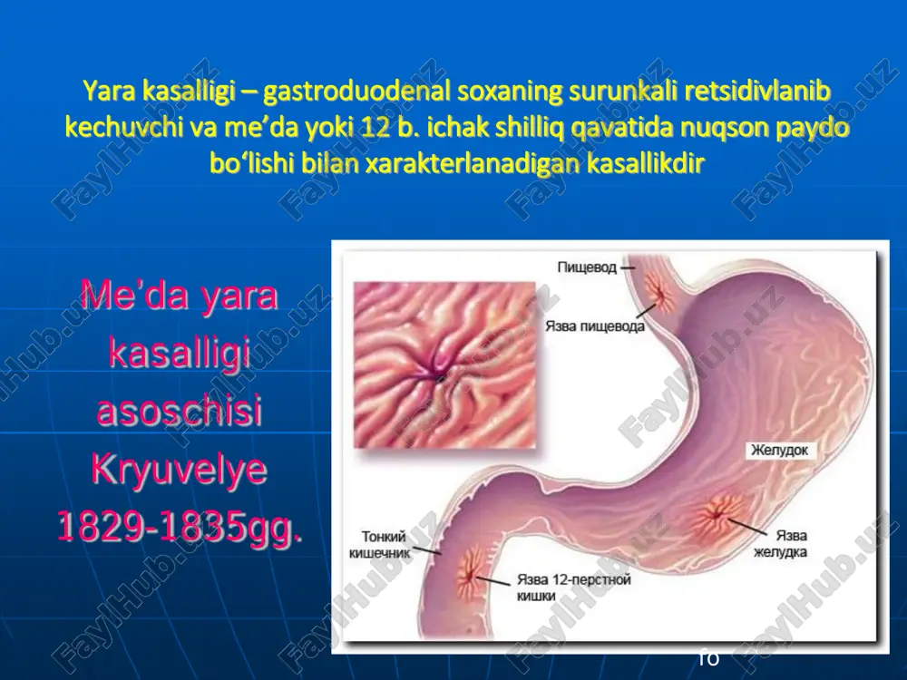 n uorren va barri marshall bu kashfiyotlari uchun nobel mukof oti bilan taqdirlanishdi klinik kechishi tipik atipik (og‘riq sindromining atipikligi). meʼda sekretsiyasi darajasi. gipersekretor giposekretor kechish xarakteriga ko‘ra. birinchi marta aniqlangan yara kasalligi retsidivik kechuvchi gox-gox qo‘zib turuvchi (2-3 yilda 1-marta qo‘zuvc hi) xar yili qo‘zuvchi tez-tez qo‘zuvchi (yiliga 2-marta yoki undan ko‘p) kasallik stadiyasi bo‘yicha  qo‘zish  remissiya:  klinik  anatomik: epitelizatsiya, chandiqlanis h ( qizil chandiq stadiyasi 4-6 xafta, o q chandiq 3-6 oy).  funksional asoratlar 1. qon ketish 3. perforatsiya 2. penetratsiya 4. stenozlanish 5. malignizatsiya. diagnostika klinik mezonlari, yosh, jins va yarani lokalizatsiyasi bo‘yicha o‘ziga xos klinikasi. qon guruxini aniqlash axlat analizi. qorin bo‘shlig‘i organlarini uzt. meʼda shirasi tekshiruvi. egds pritsel biopsiya bilan. meʼda va 12 b. ichak r-skopiyasi 8. h. pylori ni anqlash. yara tiplari. yagona bir-qancha yara o‘lchami. kichik, diametr 0,5 sm gacha. o‘rta, diametr 0,5-1 sm gacha. katta, diametr 1,1-2,9 …
