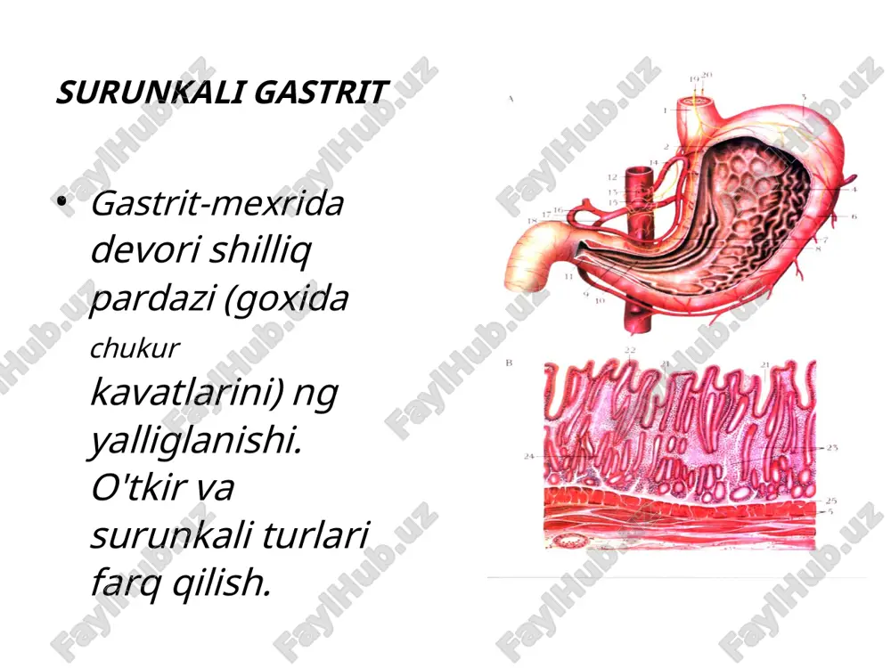 uodeno-gastral reflyuks) oshqozonga tushishi; • (3) arxitektura va 12 b. ichak mexanizmlari; • (4) helicobacter pylori; • (5) gistamin va serotonin kislotali peptik omil faolligini oshiradi va membrana o'tqazuvchanligini kuchaytiradi oshqozon va o'n ikki barmoqli ichak yara kasalligi 1. • • • • 2018-05-01 xoxlasa buladi 121 2. • • • • 3. • • • • 4. • • • • • lokallashuv oshkozon yarasi 12 barmokli ichak yarasi oshkozon va 12 b.i. yarasi birga kelishi anastamoz gastroeuynal yarasi etiologiya nr-musbat nr-manfiy simptomatik ideopatik yarash boskichlari faol bir nechta chandiq boskichi tasnifi uzok nechaiklanmaydigan asoratlari kon ketish 10-15% perforatsiya 6-20% penetratsiya 15% stenoz 6-15% malignizatsiya oshkozon kontrastli rentgenografiya fibrogastroduodenoskopiya 1 4 2018-05-01 xoxlasa buladi 121 2 3 5 oshkozon kikchik egriligida ikkita tokcha belgisi jeludka (1). kichik egriliqda yara (2). lokal spazm sababli oshkozon katta egriligi konturining ichkariga oshqozon shilliq kavatining yarali to'rtilishi (3). defekt (4) o'n ikki b. …