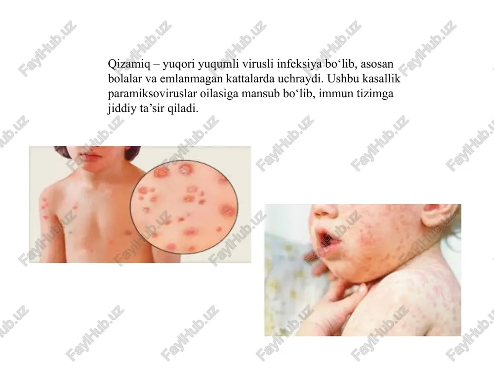 k va parhez og‘ir holatlarda kasalxonaga yotqizish profilaktika (oldini olish) qizamiqdan eng samarali himoya vositasi – vaksinatsiya! mmr vaksina → qizamiq, qizilcha va epidemik parotitga qarshi. 2 dozali vaksina 99% himoya beradi. jsst ma’lumotlariga ko‘ra, emlash tufayli qizamiq o‘lim holatlari 73% ga kamaygan. qizamiqning dunyo miqyosidagi holati 2016-yilda jsst qizamiqni butunlay yo‘q qilish rejasini e’lon qilgan. biroq, emlashga qarshi harakatlar tufayli ba’zi hududlarda qizamiq qayta avj olmoqda. o‘zbekiston qizamiqga qarshi emlashni keng miqyosda olib bormoqda. yil boshidan buyon jahon sog‘liqni saqlash tashkiloti yevropa mintaqasining 17 ta davlatida qizamiq bilan kasallanish holatlari qayd etilgan, deb xabar qilindi bmt matbuot xizmati jsst ma’lumotlariga tayanib. fevral oyining oxiriga kelib, 900 ta holat rasman qayd etilgan, bu butun 2022-yildagi ko‘rsatkichlardan ko‘p. jsstning ta’kidlashicha, barcha mamlakatlar, shu jumladan qizamiqning endemik yuqishi bartaraf etilgani tasdiqlangan davlatlar hukumatlari ushbu o‘ta yuqumli kasallikdan hushyor bo‘lishlari kerak. xulosa qizamiq – juda yuqumli va xavfli kasallik. uni faqat vaksinatsiya yordamida …