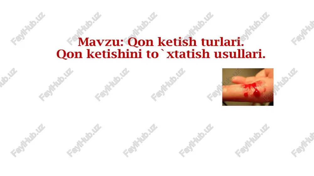 ir necha daqiqadan keyin odam o’lishi mumkin. bu hol yirik gon tomirlari arteriyalar shikastlanganda yuz beradi. @venoz - tananing gon tomirlari shikastlanganda yuz beradi. ¢kapilyar qon - gon ogishi eng mayda gon tomirlari-kapilyarlar shikastlanganda yuz beradi (terining shilinishi, uncha chuqur boimagan jarohatlar, kesib olish va h.z). jgut qo’yish texnikasi. ® jgut qo’yis! qo’ymaslik o’raladi; © jgut oyoq yoki qo’ olinib,so’ng o’rta qismida cho’ziladi,jgutni qo” yoki oyoq atrofidan q © jgut gattiq to’qimalar jon ogis jarohatl hdan oldin jgut qo’yiladigan terini qisib uchun oyoq yoki qo’lga sochiq yoki bint qisib bog’ lanmaydi, chunki uning ostidagi ostidan o’ tkaziladi, uning uchi hi to’xtaguncha aylantiriladi; anadi; ® jgutni to’e’ri go’yilganini nazorat qilish kerak.bunda jgut solingan so to’xtaydi; © jgut o’ram aridan va daqiqalari) yozi haning pastida puls yo’ qoladi,qon oqishi mita * birining ostiga jgut qo’yilgan vaqt(soat sy tga gan qog’oz qistirib qo’yiladi da vogigome “petexiya” “purpura” (teri ostida (shilliq parda toplanib qolg …