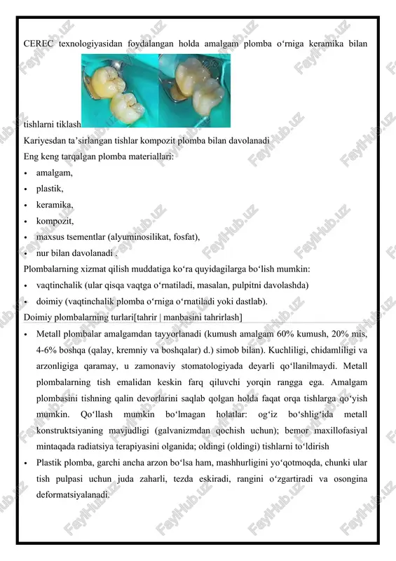 bilan davolanadi . plombalarning xizmat qilish muddatiga koʻra quyidagilarga boʻlish mumkin: · vaqtinchalik (ular qisqa vaqtga oʻrnatiladi, masalan, pulpitni davolashda) · doimiy (vaqtinchalik plomba oʻrniga oʻrnatiladi yoki dastlab). doimiy plombalarning turlari[tahrir | manbasini tahrirlash] · metall plombalar amalgamdan tayyorlanadi (kumush amalgam 60% kumush, 20% mis, 4-6% boshqa (qalay, kremniy va boshqalar) d.) simob bilan). kuchliligi, chidamliligi va arzonligiga qaramay, u zamonaviy stomatologiyada deyarli qoʻllanilmaydi. metall plombalarning tish emalidan keskin farq qiluvchi yorqin rangga ega. amalgam plombasini tishning qalin devorlarini saqlab qolgan holda faqat orqa tishlarga qoʻyish mumkin. qoʻllash mumkin boʻlmagan holatlar: ogʻiz boʻshligʻida metall konstruktsiyaning mavjudligi (galvanizmdan qochish uchun); bemor maxillofasiyal mintaqada radiatsiya terapiyasini olganida; oldingi (oldingi) tishlarni toʻldirish · plastik plomba, garchi ancha arzon boʻlsa ham, mashhurligini yoʻqotmoqda, chunki ular tish pulpasi uchun juda zaharli, tezda eskiradi, rangini oʻzgartiradi va osongina deformatsiyalanadi. · tsement plombalarining past kuchi va ishonchliligi bor. ular uzoq davom etmaydi, ammo ular qisqa muddatli qattiqlashuvga …