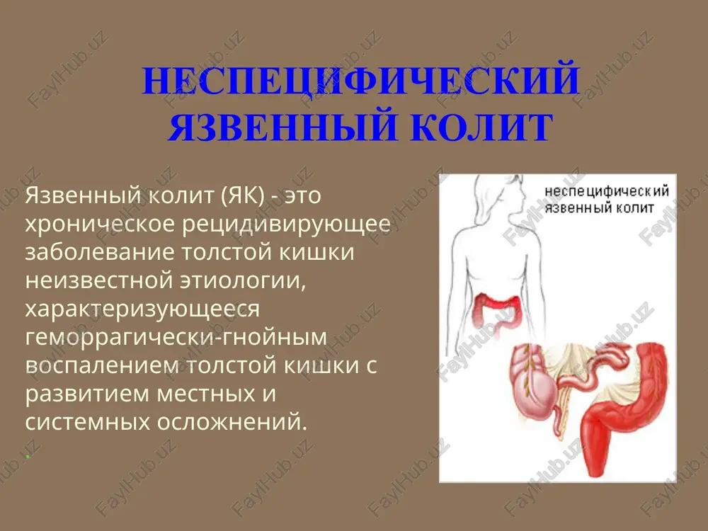 ano, chto stress zapuskaet retsidivi kolita u jivotnix, veroyatno, posredstvom umensheniya kolichestva mutsina tolstoy kishki i povisheniya pronitsaemosti kishechnika. * patogenez nyak (mikrobnie faktori ) u jivotnix, podvergnutim gennoy injenerii i jivushim v iskusstvennoy srede, v kotoroy otsutstvuyut spetsificheskie vozbuditeli razvivaetsya yazvenniy kolit, esli oni vxodyat v kontakt s nepatogennoy bakterialnoy mikrofloroy, xarakternoy dlya tolstoy kishki, prichem eta bolezn ne razvivaetsya v sterilnoy srede, lishennoy mikrobov. bolee togo, eksperimentalniy kolit oslabevaet, esli jivotnix lechat antibiotikami shirokogo spektra deystviya * patogenez nyak (immunologicheskie faktori ) pri yazvennom kolite rastet populyatsiya v-limfotsitov i plazmotsitov. ranshe eto rassmatrivalos kak dokazatelstvo gipotezi, soglasno kotoroy razvitie yazvennogo kolita zavisit ot antitel i komplementa. odnako, v nastoyashee vremya samim vajnim narusheniem i dvijushey siloy vospaleniya schitaetsya chrezmernaya reaktsiya so storoni t-limfotsitov, opredelyayushaya giperreaktsiyu slizistoy na bakterii * klassifikatsiya nyak po xarakteru klinicheskogo protekaniya yak: – ostriy, ostriy molnienosniy, xronicheskiy retsidivniy, xronicheskiy neprerivniy; po stepeni tyajesti: legkiy, …