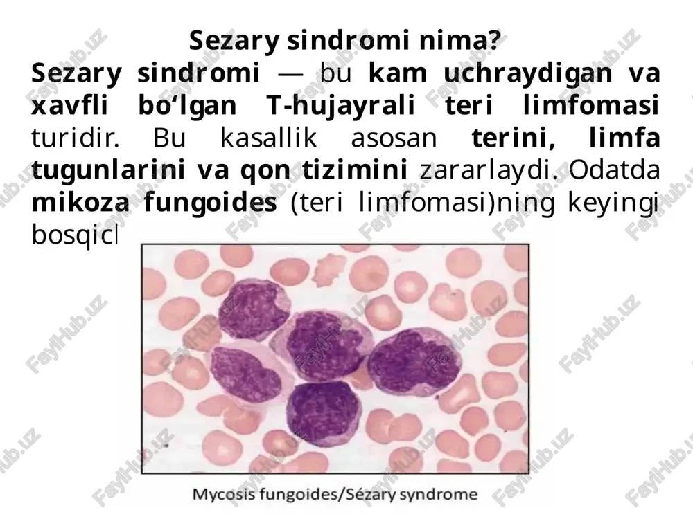 siz, ammo sezilarli bo‘lishi mumkin. ⚙️ 1. noto‘g‘ri ishlovchi t-hujayralarning paydo bo‘lishi: bu kasallik cd4+ t-limfotsitlari (yordamchi t-hujayralar)ning genetik mutatsiyaga uchrashi bilan boshlanadi. ular yovvoyi tarzda ko‘payadi va normal immun funksiyalarini yo‘qotadi. 2. noto‘g‘ri t-hujayralarning qon va teriga tarqalishi: anormal t-hujayralar qonda to‘planadi (shu sababli bu kasallik leukemik xarakterga ega). so‘ng ular teriga “hujum qiladi”, bu esa qizarish, qichishish va yallig‘lanishga olib keladi. 3. sezary hujayralari organizmga zarar yetkazadi: ushbu hujayralar organizmni o‘ziga qarshi ishlashga majbur qiladi (avtoimmun tus). teri hujayralari doimiy ravishda yallig‘lanadi va yangilanmay qoladi. teri qatlamlari o‘z tuzilishini yo‘qotib, eritrodermiyaga olib keladi. 4. immunitetning izdan chiqishi: normal t-hujayralarning o‘rnini sezary hujayralari egallaydi. natijada immunitet zaiflashadi → bemor tez-tez infeksiyaga chalinadi. hujayralar limfa tugunlari va boshqa organlarga tarqalib, sistematik kasallikka aylanadi. 5. kasallikning progressiv rivojlanishi: kasallik surunkali, lekin yomonlashib boruvchi tus oladi. agar davolanmasa yoki kech aniqlansa, hujayralar ichki organlarga (jigar, taloq, suyak iligi) ham tarqalishi mumkin. 💊 …