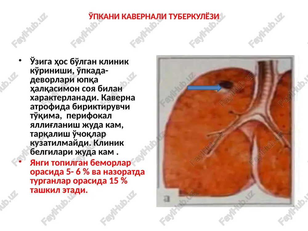 sil tayokchani manbasi xisoblanadi uni ichida 1012 mikobakteriyalar mavjud kaverna shakllanish patogenezi vidi kavern: “shtamplangan ”; alterativ (proteolitik); ateramatoz; sekvestirlovchi- kazeoz masslar yumshaydi, chekadan boshlab markaz yo'nalishida bronxogennie; bronxogen psevdotuberkuloma; kavernalarni turi o'lchami bo'yicha: mayda- 2smgacha; o'rta- 2- 4 sm; yirik- 4-6 sm; gigant- 6 sm katta kovakni o'pkalarda tipik joylashuvi: 1,2,6 segmenti kovakni devorlarni holati bo'yicha: elastik; regid; fibrozli shakllanish muddatiga qarab: o'tkir shakllanayotgan; yangi; eski tuberkulyoz kavernani patologo-anatomik ko'rinishi va gistogrammasi ichki qatlami- kazeoz-nekrozli; o'rta- tuberkulyoz granulyatsiyasi; tashqi qatlami- biriktiruvchi to'qima kavernani patogenetik xarakteristikasiga asoslanib ftiziatriyada kavernoz tuberkulyozni quyidagi turlari farqlanadi: yangi shakllanayotgan kaverna – emirilish bosqichiga to'g'ri keladi, bunda kazeoz massa parchalanishni boshlagan, lekin o'pka to'qimasidan hali yaqqol chegaralanmagan ; elastik kovak – emirilish bosqichida kovakniikki qatlamli (piogen va granulyatsion ) shakllannishni boshlagan ; kapsula bilan o'ralgan – haqiqiy kavernali tuberkulyoz kovakda aniq 3 qatlami to'la shakllangan; fibroz- kavernali – kovakni tashqi- biriktiruvchi to'qimadan iborat dag'al qatlam …