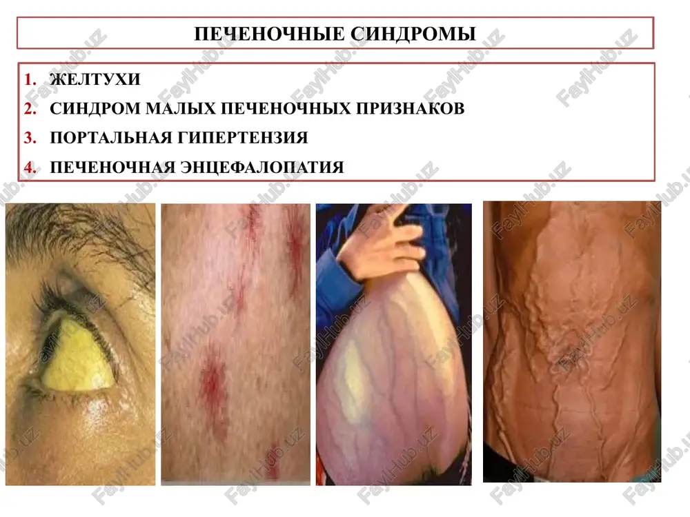 idnoy etnicheskoy prinadlejnosti; neobxodimo znat, kakie drugie prichini mogut vizvat jeltushnost kojnix pokrovov: peredozirovka karotinoidov, avtozagar i t.d. 4 gemoliticheskaya jeltuxa, etiologiya i mexanizm razvitiya nadpechenochnie (gemoliticheskie) jeltuxi razvivayutsya pri zabolevaniyax, xarakterizuyushixsya usilennim razrusheniem eritrotsitov i obrazovaniem bolshogo kolichestva nepryamogo bilirubina, zaxvat kotorogo polnostyu ne mogut obespechit daje normalno funktsioniruyushie gepatotsiti. prichini: korpuskulyarnie, svyazannie s izmeneniem strukturi i funktsii eritrotsitov (autoimmunnie gemoliticheskie anemii, mikrosferotsitoz - bolezn minkovskogo-shoffara, serpovidnokletochnaya anemiya, v12-folievodefitsitnaya anemiya i t.d.). ekstrakorpuskulyarnie – obuslovlennie vozdeystviem na eritrotsiti vneshnix faktorov (antitel – pri perelivanii nesovmestimoy krovi, rezus konflikte, gemoliticheskix yadov, gemolizinov razlichnix infektsionnix agentov i samix vozbuditeley). vnesosudistiy gemoliz eritrotsitov – rassasivanie massivnix gematom. gemoliticheskaya jeltuxa, klinicheskie proyavleniya koja limonno-jeltogo ottenka – za schet bolshogo kolichestva v krovi nekonyugirovannogo (nepryamogo) bilirubina. v mochu bilirubin ne popadaet, tak kak v nekonyugirovannom vide on ne mojet proyti cherez pochechniy barer. mocha priobretaet bolee temniy ottenok (izbitochnoe obrazovanie svyazannogo bilirubina privodit k …