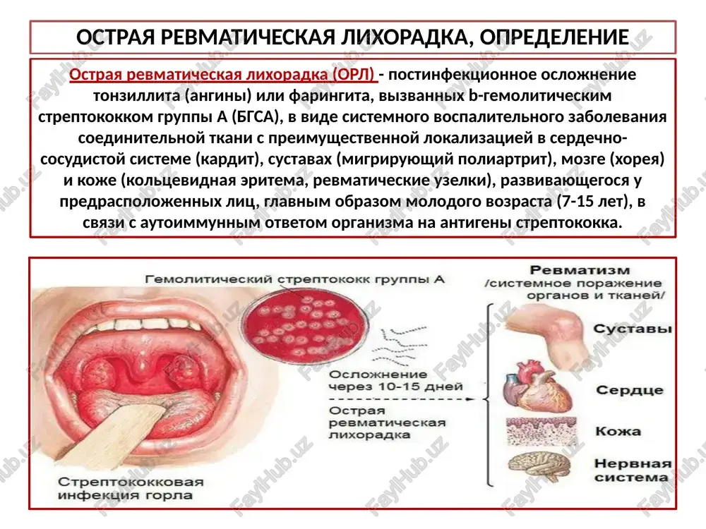ya poyavleniem lixoradki i simptomov obshey intoksikatsii, na fone kotorix razvivayutsya takie tipichnie proyavleniya, kak artrit, revmokardit, koltsevidnaya eritema, malaya xoreya i podkojnie revmaticheskie uzelki. lixoradka u bolnix revmatizmom v debyute zabolevaniya obichno dostigaet 39°s i vishe. febrilnaya lixoradka, kak pravilo, soxranyaetsya ne bolee nedeli, posle chego smenyaetsya zatyajnim subfebrilitetom, libo temperatura tela normalizuetsya. lixoradochnaya reaktsiya soprovojdaetsya simptomami obshey intoksikatsii (slabost, potlivost) . bolshie: kardit, poliartrit, xoreya, koltsevidnaya eritema, podkojnie uzelki. malie: artralgii, lixoradka. laboratornie: ostrie fazovie reaktsii - povishenie soe, leykotsitoz, poyavlenie s reaktivnogo blka, udlinenie r-q na ekg. nalichie dvux bolshix ili odnogo bolshogo i dvux malix proyavleniy i dokazatelstva predshestvuyushey streptokokkovoy infektsii podtverjdayut diagnoz revmatizma. diagnosticheskie kriterii revmatizma po dannim voz (1988) revmaticheskiy artrit v patologicheskiy protsess odnovremenno vovlekaetsya neskolko krupnix i srednix sustavov nijnix i, reje, verxnix konechnostey. lokalizatsiya chastaya kolennie sustavi, golenostopnie sustavi, loktevie sustavi, luchezapyastnie sustavi. xarakteristika v pervoy atake v 75% sluchaev, neredko …