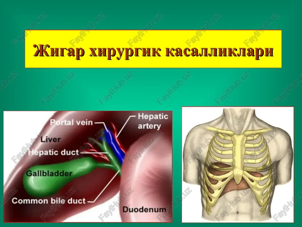 matoz a'zolar jarohati belgilari ??? laparoskopiya laparotsentez izlovchi kateter maxsus diagnostika usullari jigar jarohatlarida jigar to'qimasiga chok qo'yish usullari jigar cheti jarohatiga chok qo'yish jigar jarohatiga chok qo'yish taxokomb gemostatik muolajasi amaliyotdan keyingi asoratlar qorin bo'shlig'iga qon ketishi, o't suyuqligini qorin bo'shlig'iga oqishi va o'tli peritonit rivojlanishi, mexanik sariqlik, xoliemiya, jigar etishmovchiligi, qorin bo'shlig'i abstsesslari, sepsis, nospetsifik asoratlar. jigar exinokokki jigar exinokokki jigar exinokokki uzi kt kt kt kt jigar exinokokkozi xitin pardasi dochernie puziri tuxumlari maxsus moslama - so'rg'ichlar laparoskopik operatsiyalar uchun asbob-uskunalar endoskopik moslama asboblar minilaparotomiya moslama laparoskopik exinokokkektomiya b-8€ syndis cystic duct common bile duct duodenum nijnyaya poverxnost pecheni verxnyaya i nijnyaya poverxnost verxnyaya puc. 4-8. mraoit bepewia marko nyhkthpyior 6pioulnyio nonocts. puc. 4-13. a — seenenue nepsoro tpoakapa.