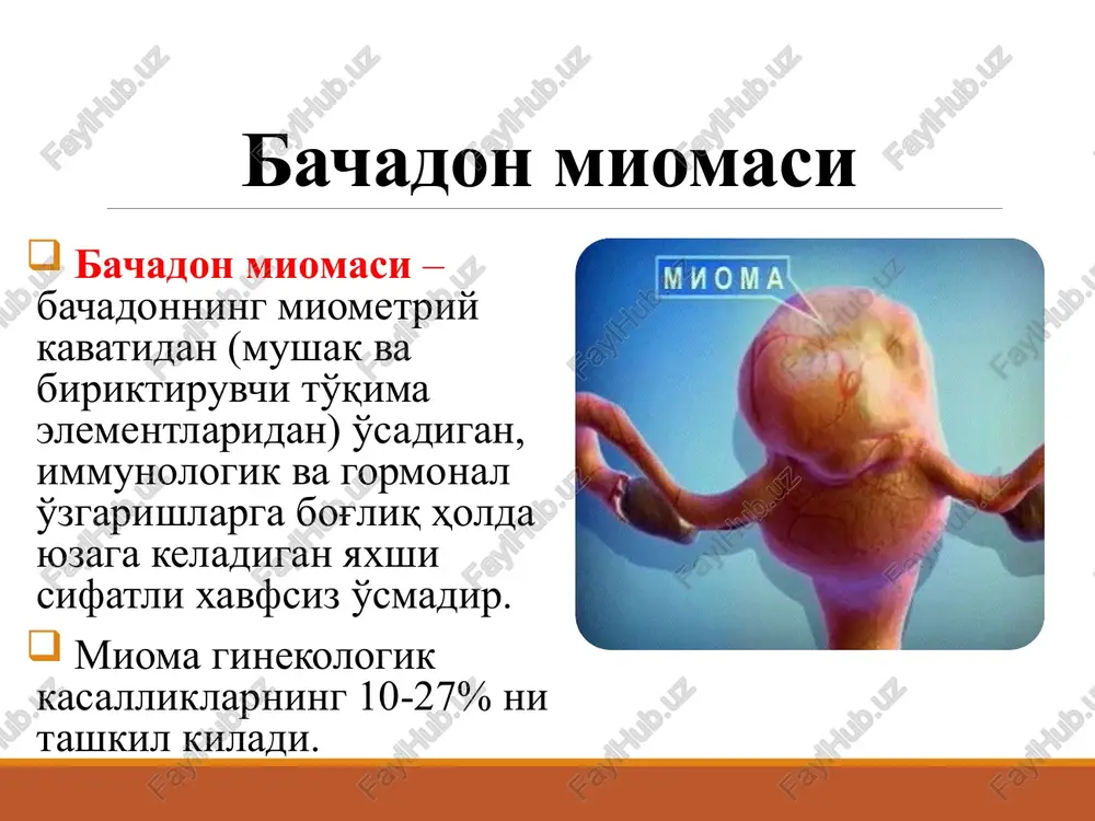 illari xavf omillarini kamaytiradi: 1. aok ko'llanilishi 2.fizicheskaya aktivnost 3. anamnezda 3 va undan ortik tugruk yuqori xavf omillari: 1.erta menarxe 2. anamnezda homiladorlik va tug'ruq yo'qligi 3. kechki reproduktiv yosh 4. ortikcha tana vazni 5. yomon odatlar (alkogol, chekish) klassifikatsiya miomatoz tugunlarning turi: subseroz – korin bo'shlig'i tomon o'sishi (podbryushinnaya); submukoz – mioma bachadon bo'shlig'i tomon o'sishi (podslizistaya); interstitsial – muskullararo o'sishi (intramuralnaya); intraligamentar – bog'lamlar orasidagi mioma submukoz mioma subseroz mioma interstitsial mioma ko'p tugunli bachadon miomasi o'sma morfologik xususiyatiga kura fibromioma – biriktiruvchi to'qimadan iborat; rabdomioma – ko'ndalang-bo'ylama mushak xujayralaridan tashkil topgan o'sma. leyomioma – miometriyning silliq mushak to'qimasidan iborat leyomioma fibromioma klassifikatsiya (figo, 2011) turlari: 0 – submukoz; 1 – submukoz, ˂50% intramural komponent; 2 – submukoz, 50% intramural komponent; 3 – intramural, endometriyga yakin; 4 – intramural; 5 – subseroz, >50% intramural komponent; 6 – subseroz, ˂50% intramural komponent; 7 – subseroz; 8 – boshka …