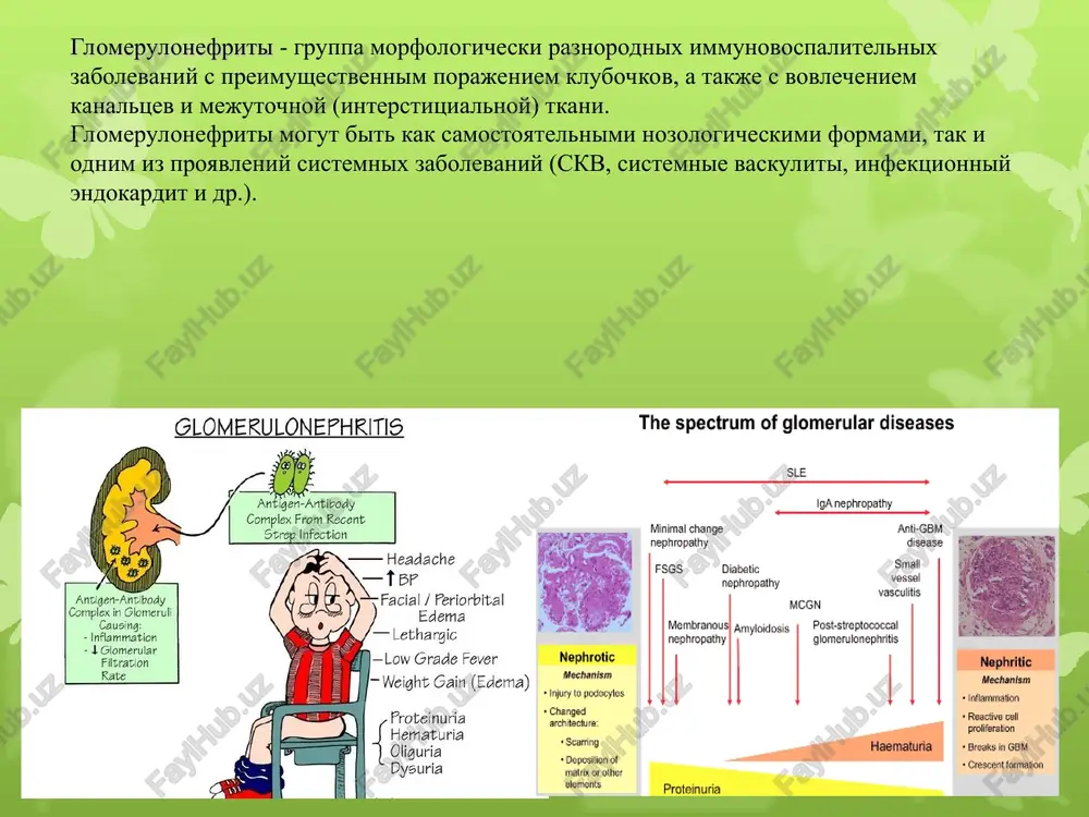 ak i insolyatsiya (pri volchanochnom glomerulonefrite). klassifikatsiya klassifikatsiya glomerulonefritov osnovivaetsya na videlenii: • vedushego sindroma (gematuricheskiy, gipertonicheskiy, nefroticheskiy); • varianta techeniya (ostriy, xronicheskiy i bistroprogressiruyushiy); • tipa morfologicheskix izmeneniy (proliferativnie i neproliferativnie formi). proliferativnie formi neproliferativnie formi ostriy poststreptokokkoviy (intrakapillyarniy) glomerulonefrit fokalno-segmentarniy glomeruloskleroz bistroprogressiruyushiy glomerulonefrit: s immunnimi depozitami; malo(pauci)immunniy* membranozniy glomerulonefrit mezangioproliferativniy glomerulonefrit glomerulonefrit s minimalnimi izmeneniyami iga-nefropatiya mezangiokapillyarniy glomerulonefrit ostriy poststreptokokkoviy glomerulonefrit ostriy poststreptokkokkoviy glomerulonefrit - diffuznoe immunokompleksnoe vospalenie pochechnix klubochkov, razvivayusheesya cherez 2-3 ned posle antigennogo vozdeystviya i klinicheski proyavlyayusheesya ostronefriticheskim sindromom. morfologicheski sootvetstvuet kartine proliferativnogo intrakapillyarnogo glomerulonefrita. zabolevanie razvivaetsya u lits molodogo vozrasta, v poslednee vremya vstrechaetsya v pojilom i starcheskom vozraste. v 2 raza chashe razvivaetsya u mujchin, chem u jenshin. etiologiya i patogenez razvitie svyazivayut s nefritogennimi shtammami β-gemoliticheskogo streptokokka gruppi a (shtammi 1, 2, 4, 12, 18, 25, 49, 55, 58 i 60). v ostruyu stadiyu zabolevaniya na bazalnoy membrane klubochkov i/ili v mezagialnoy …