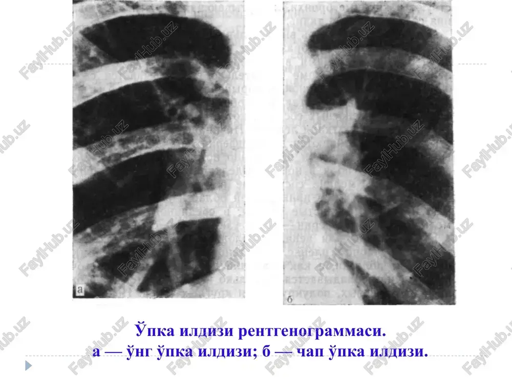 ishi stafilokokkli zotiljam krupoz zotiljam tvorogsimon zotiljam o'pka gangrenasi o'pka tsirrozi (sklerozi) bronxoektatik tsirroz (surunkali zotiljam) sil tsirrozi plevra bo'shlig'idagi suyuqlik turli etiologiyali ekssudativ plevrit plevral shvartlar pantsir (sovutli) plevrit (ohaklangan shvart yoki ohaklanmagan shvart) pulmonektomiyadan keyingi fibrotoraks ko'krak bo'shlig'ida qorin a'zolarining bo'lishi diafragmal churra 93 rasm – 26 masala 94 rasm – 27 masala o'pka maydonidagi chegaralangan qorayishi o'pka maydonidagi chegaralangan qorayish sindromini beruvchi asosiy kasalliklar patologik jarayon (holati) kasalliklar atelektaz (bo'lak, segment) bo'lak yoki segmentar bronx bilan o'sgan o'pka saramasi. bo'lak yoki segmentar bronxdagi yot jism o'pkaning yallig'langan qismi turli etiologiyali o'tkir bakterial va virusli zotiljam infiltrativ sil o'pkaning tsirroz qismi bronxoektatik tsirroz (surunkali zotiljam) silli (tuberkulezniy) tsirroz o'pka o'smasi yirik bronx saratoni plevra bo'shlig'ida suyuqlik bo'lishi gidrotoraks, gemotoraks ekssudativ plevrit plevral shvartlar jarrohlik aralashmalaridan shikastlangan plevritlardan keyin ko'krak bo'shlig'ida qorin a'zolarining bo'lishi diafragmal churra o'pka maydonidagi sharsimon (yumaloq, oval) soya 106 rasm – 35 masala 107 rasm …