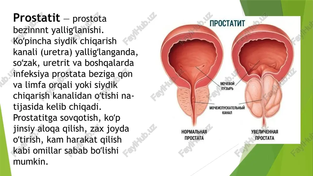 ili, siydikning umumiy tahlili, yallig'lanishning o'tkir bosqichida oqsil miqdori haqida ma'lumot olish uchun qonning biokimyoviy tahlili. qaysi dori vositalari kasallik bilan eng yaxshi kurashishini aniqlash uchun bakterioskopiya va antibiotiklarga sezuvchanlikni tekshirish uchun uretradan surtma olinadi. kasallikning o'tkir turida prostata bezini qo`l bilan tekshirilmaydi, chunki bu infeksiyaning tarqalishiga olib kelishi mumkin va kasallikni aniqlash utt yordamida amalga oshiriladi. agar shifokor abssess borligiga shubha qilsa, mrt yoki kt tekshiruvlarini buyurishi mumkin. 2.surunkali prostatit--boʻlgan bemorlarga dori-darmonlar, fizioterapiya, shuningdek, sanatoriy va kurortlarda davolanish tavsiya etiladi. kasallik zoʻriqqanda achchiq, shoʻr ovqatlar, spirtli ichimliklar, jinsiy aloqa taqiqlanadi. prostatitning oldini olishda siydik chiqarish kanali, qovuqning yalligʻlanish kasalliklarini oʻz vaqtida aniqlab, batamom davolash va ichni ravon yurgizib turishga ahamiyat berish lozim. uzoq oʻtirib ishlaydigan kishilar piyoda sayr qilishlari, yugurish, suzish, tennis va sportning boshqa turlari bilan shugʻullanib turishlari kerak. oraliq, chov va qov tepasidagi og`riq;; prostataning kattalashishi bilan bo`liq peshob chiqarishning buzilishi, tez-tez og`riqli peshobga chiqish;; jinsiy tomondan …