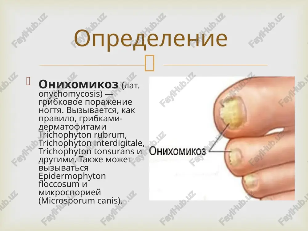 chastichno razrushaetsya, osobenno s bokov. neredko bolnie ispitivayut bol pri xodbe.  simptomi dlya onixoliticheskogo tipa xarakterna tusklaya burovato-seraya okraska porajennoy chasti nogtya, ee istonchenie i ottorjenie ot loja; obnajenniy uchastok pokrit rixlimi nasloeniyami.  lechenie preparatom vibora pri lechenii onixomikoza lyuboy lokalizatsii yavlyaetsya terbinafin. ego naznachayut vzroslim i detyam vesom bolee 10 kg po 250 mg v sutki v techenie 6 ned. detyam ot 2 let vesom menee 20 kg terbinafin naznachayut iz rascheta 67,5 mg/kg v sutki, ot 20 do 40 kg — 125 mg/kg v sutki v techenie 6 ned. preparatami rezerva yavlyayutsya sredstva, soderjashie itrakonazol i flukonazol. itrakonazol primenyaetsya po dvum sxemam: po 200 mg ejednevno v techenie 3 mes ili po 200 mg dvajdi v den v techenie 7 dney na pervoy i pyatoy nedelyax s nachala terapii. dlya lecheniya onixomikozov u detey itrakonazol ne naznachaetsya. flukonazol rekomenduetsya prinimat po 150 mg 1 raz v …