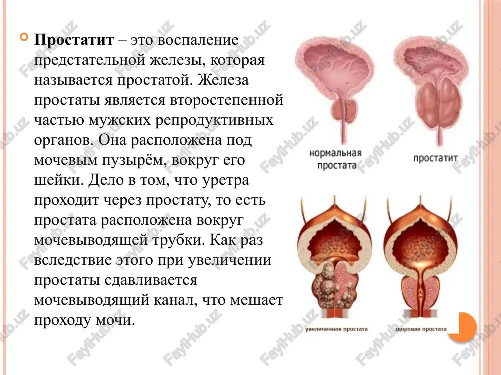 st, potlivost pri xronicheskom prostatite simptomi voobshe mogut otsutstvovat. poetomu ochen vajno proxodit profilakticheskie osmotri, chto viyavit zabolevanie na rannix stadiyax. tem ne menee na vospalenie prostati mogut ukazivat sleduyushie simptomi. simptomi xronicheskogo prostatita: periodicheskie boli v promejnosti, nad lobkom, v paxovoy oblasti boleznennoe, uchashennoe mocheispuskanie videleniya iz mocheispuskatelnogo kanala pri defekatsii oslablenie erektsii izmenenie dlitelnosti polovogo akta izmenenie seksualnix oshusheniy nebolshoe povishenie temperaturi osnovnie priznaki prostatita 1)boli vnizu jivota,moshonke,promejnosti 2)rasstroystvo mocheispuskaniya 3)rasstroystvo polovoy funktsii(seksualnoy disfunktsii) 4)izmenenie kolichestva i kachestva eyakulyata 5)rasstroystvo eyakulyatsii xronicheskiy prostatit otlichaetsya dlitelnim i upornim techeniem,u nekotorix bolnix on protekaet bez chetkix klinicheskix simptomov. osobennosti zabolevaniya i klinicheskogo techeniya prostatita zavisyat ot mnogix prichin: fazi aktivnosti vospalitelnogo protsessa dlitelnosti zabolevaniya stepeni vovlecheniya v patologicheskiy protsess sosednix organov,prodoljayushegosya vliyaniya na techenie bolezni malopodvijniy obraz jizni neregulyarnie polovie akti i t.d. sushestvuet osnovnie diagnosticheskie kriterii: - rektalnoe (cherez pryamuyu kishki) paltsevoe issledovanie predstatelnoy jelezi. v polzu prostatita svidetelstvuet …
