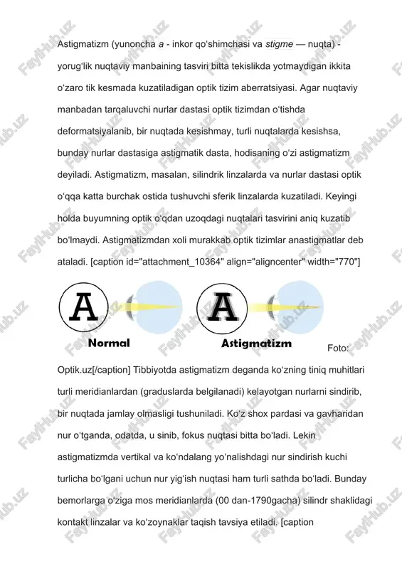 uning o‘ta og‘ir turi birikkan astigmatizm bo‘lib, kishi bunda yaqin masofadan ham, uzoqdan ham yaxshi ko‘ra olmaydi. [caption id="attachment_10370" align="aligncenter" width="600"]foto: metroparent.com[/caption] ba’zi hollarda inson astigmatizm xastaligi bilan og‘riganini payqamay qolishi ham mumkin. biroq boshda og‘riq paydo bo‘lishi, narsalarning chaplashib yoki ikkita bo‘lib ko‘rinishi, kompyuter yoxud kitobdan ko‘zning tez toliqishi kabi belgilar yuz ko‘rsatsa, darhol mutaxassisga murojaat qilish lozim. ko‘z shifokori maxsus jadval va silindrsimon linzalar ko‘magida ko‘rish a’zosini tekshirib, aniq tashxis qo‘yib beradi. astigmatizmni maxsus linza yoki ko‘zoynaklar orqali bartaraf etish mumkin. undan batamom xalos bo‘lish esa jarrohlik amaliyotini taqozo etadi. davo choralari ichida birmuncha samarali va xavfsiz hisoblangani “lasik” deb atalmish ko‘rishni lazer yordamida davolash usulidir. 15 daqiqacha davom etuvchi lazer jarrohligi asnosida avval maxsus asbob yordamida muguz pardaning ustki qatlami kesib olinadi. so‘ng unga lazer yordamida ishlov berilib, sferik holga keltiriladi. shundan keyin muguz parda joyiga qaytarib qo‘yiladi va o‘zida mavjud kollagen moddasi hisobiga holatini tiklab oladi. …