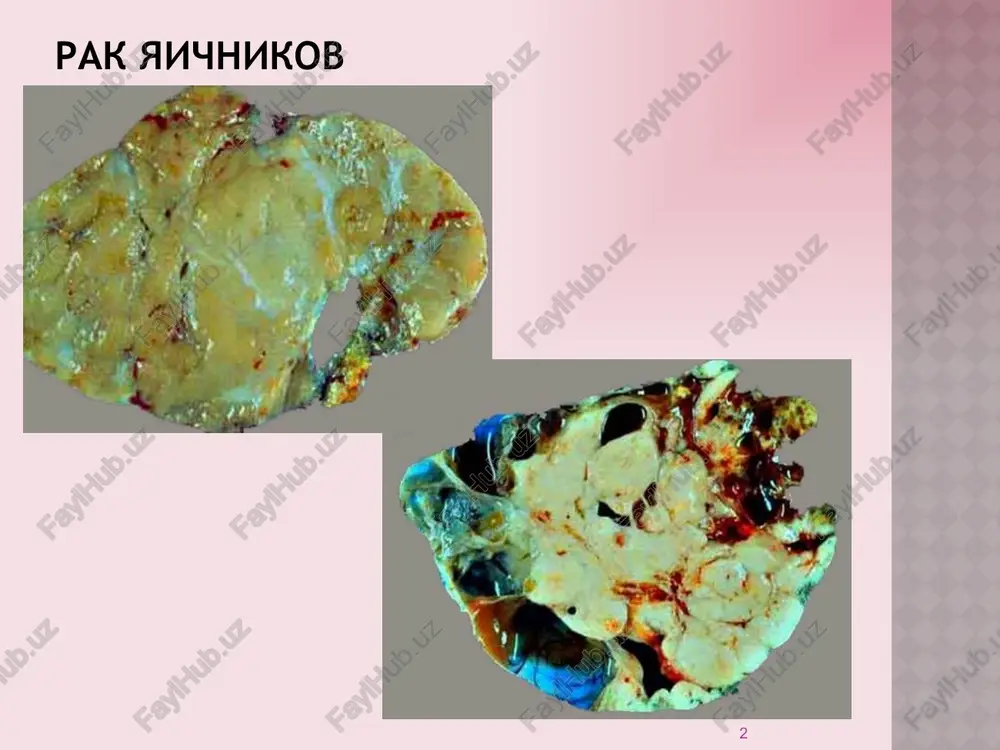 nijayushie veroyatnost vozniknoveniya rya: beremennosti i rodi; bolshoe kolichestvo detey; kormlenie grudyu; xronicheskaya anovulyatsiya; peroralnie kontratseptivnie preparati (pkp). 7 etiologiya rya ovulyatornaya gipoteza risk vozniknoveniya rya pryamo proportsionalen chislu reparatsiy pokrovnogo epiteliya yaichnikov posle ovulyatornix tsiklov v techenie vsey jizni jenshini. 8 etiologiya rya nasledstvennie faktori. v 5-10% sluchaev rak yaichnikov predstavlen nasledstvennim rakovim sindromom (obichno semeynie sluchai raka molochnoy jelezi – yaichnikov). bolshinstvo sluchaev voznikaet v rezultate mutatsiy genov brca1 i brca2 v germinativnix kletkax. v 93-95% rya yavlyaetsya sporadicheskim, xotya rol geneticheskix faktorov v etiologii rya nesomnenna. 9 morfologiya rya istochnik epitelialnix opuxoley – kisti-vklyucheniya. voznikli v rezultate otshnurovaniya invaginirovannogo pokrovnogo mezoteliya s differentsirovkoy kletok kak v storonu trubnogo epiteliya, tak i v storonu endotservikalnogo epiteliya. germinogennie opuxoli voznikayut iz zarodishevix kletok. stromalno-kletochnie opuxoli voznikayut iz mezenximalnix kletok. 10 morfologiya rya 11 morfologiya rya 12 morfologiya rya 13 morfologiya rya vajniy fakt: na sovremennom etape razvitiya meditsinskoy nauki …
