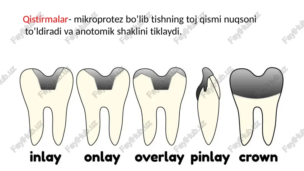 ; kak elementi shtiftovix zubov ili iskusstvennoy kulti so shtiftom; kak opornie elementi mostovidnix protezov nebolshoy protyajennosti (ne bolee 1-2 udalennix zubov); kak elementi shiniruyushix konstruktsiy pri lechenii zabolevaniy parodonta. pokazaniya dlya primeneniya vkladok karioznie polosti nebolshix razmerov (pri znacheniyax iropz menee 0,3); znachitelnoe razrushenie koronkovoy chasti zuba pri znacheniyax iropz bolee 0,6; zubi s nepolnotsennimi (xrupkimi, diskaltsinirovannimi) tverdimi tkanyami; zubi s ploxo dostupnimi polostyami. protivopokazaniya dlya primeneniya vkladok inlay turdagi qistirma uchun qanday yuza hosil qilish overlay turdagi qistirma uchun qanday yuza hosil qilish vinirlarni to’g’ridan to’g’ri yasash usuli bilvosita vinirlarni yasash usullari kompozit va keramik material bilan bilvosita vinirlarni yasash usullari vinirlar vinirlar – tishning toj qismi uchun yechilmaydigan mikriprotez. tishning anatomik shaklini tiklash va tish rangini tiklash (yoki o'zgartirish) uchun ishlatiladi. ko’rsatmalar: tishlar orasidagi bo'shliqlar va nuqsonlar; tish shakli nuqsonlarida; ponasimon nuqsonlarda; tishlarning yemirilishining ikkinchi darajasidan oshmaganda; tish emalidagi yoriqlarida; tish rangining o'zgarishi (travma, depulpatsiya qilingan tish, …