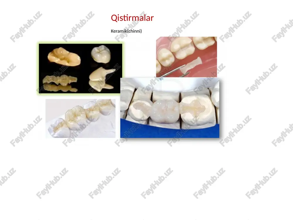 massani cho'kishi hisobiga qayta chinni massa beriladi. cho'kishni kompensatsiya qilish uchun. 6. yana pechda pishiriladi. 7. bo'linadigan modelga qistirma qo'yiladi ortiqcha qism olib tashlanadi. 8. qistirmani yuzasiga emal qavati, bo'yoqlar beriladi va glazurlanadi. chinnida qistirma yasashning texnik bosqichlari olovga chidamli model yordamida: 1. supergips yordamida olovga chidamli bo'linadigan ishchi model yasaladi va olovga chidamli material yordamida tish shtamplari nusxalari olinadi. 2. olovga chidamli modelda qistirma uchun yuzada chinni massa yordamida to'g'ridan-to'g'ri qistirma yasaladi. bunda keramik massa kondentsatsiyasi va ortiqcha namlik yo'qotiladi. 3. olovga chidamli tish shtamplaridagi chinni massa pechda pishiriladi. 4. birinchi pishirishdan so'ngyana chinni qo'shiladi, sababi chinni qisqarishini kompensatsiya qilish uchun. 5. yana chinni massa pechda pishiriladi. 6. supergipsdan yasalgan modelga chinni qistirma qo'yiladi va ortiqcha qismi olib tashlanadi. 7. qistirma yuzasiga emal qavati bo'yoqlar qo'shiladi va glazurlanadi. qavatma-qavat keramik massani qo’llash: ramka ustida olovga chidamli (refraktor) gips modelida dala shpati keramikasi turli xil rang va turli xil soyali …