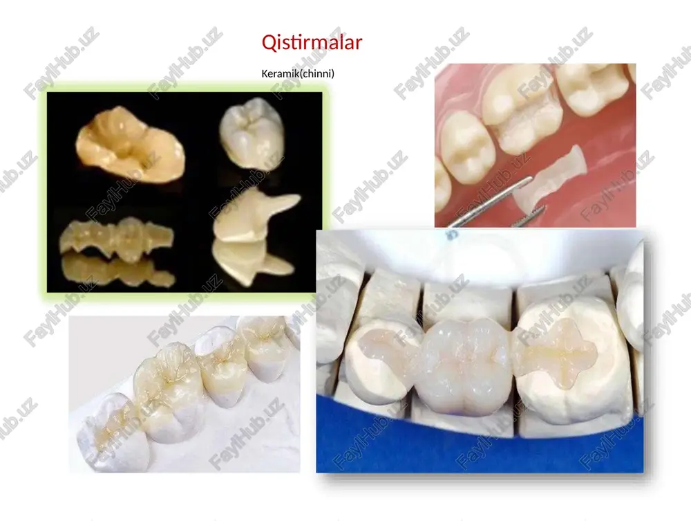 kishi hisobiga qayta chinni massa beriladi. cho'kishni kompensatsiya qilish uchun. 6. yana pechda pishiriladi. 7. bo'linadigan modelga qistirma qo'yiladi ortiqcha qism olib tashlanadi. 8. qistirmani yuzasiga emal qavati, bo'yoqlar beriladi va glazurlanadi. chinnida qistirma yasashning texnik bosqichlari olovga chidamli model yordamida: 1. supergips yordamida olovga chidamli bo'linadigan ishchi model yasaladi va olovga chidamli material yordamida tish shtamplari nusxalari olinadi. 2. olovga chidamli modelda qistirma uchun yuzada chinni massa yordamida to'g'ridan-to'g'ri qistirma yasaladi. bunda keramik massa kondentsatsiyasi va ortiqcha namlik yo'qotiladi. 3. olovga chidamli tish shtamplaridagi chinni massa pechda pishiriladi. 4. birinchi pishirishdan so'ngyana chinni qo'shiladi, sababi chinni qisqarishini kompensatsiya qilish uchun. 5. yana chinni massa pechda pishiriladi. 6. supergipsdan yasalgan modelga chinni qistirma qo'yiladi va ortiqcha qismi olib tashlanadi. 7. qistirma yuzasiga emal qavati bo'yoqlar qo'shiladi va glazurlanadi. qavatma-qavat keramik massani qo’llash: ramka ustida olovga chidamli (refraktor) gips modelida dala shpati keramikasi turli xil rang va turli xil soyali bankalarda …