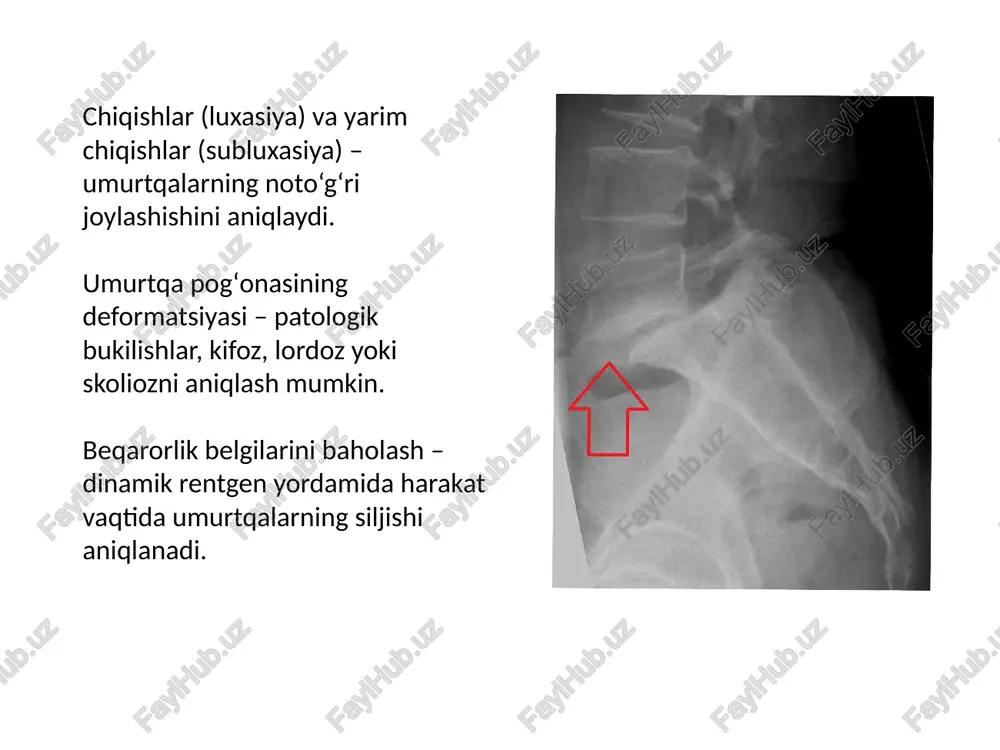 siqilgan yoki shikastlanganligini aniqlashga yordam beradi. yumshoq to‘qimalar holatini ko‘rsatish – ligamentlar, muskullar va orqa miya atrofidagi boshqa to‘qimalarni baholaydi. ionlashtiruvchi nurlanish yo‘qligi – mrt nurlanishsiz tekshiruv usuli bo‘lib, xavfsizroq hisoblanadi. image1.jpeg image2.png image3.jpeg image4.jpeg image5.png