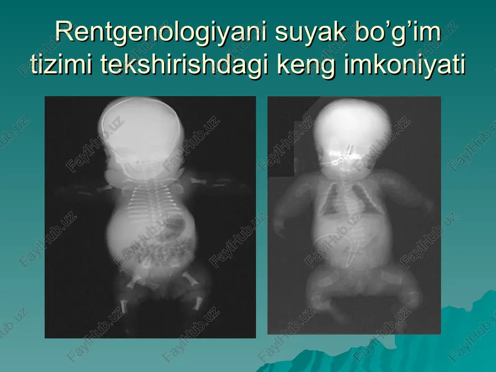 nital patologiya, metabolik kasalliklar); artikulyar yuzalar shaklidagi o'zgarishlar (travma, yallig'lanish, degenerativ jarayonlar, o'sma) suyak shakli o’zgarishi deformatsiyasi shakli o’zgarishi 1.7. qo'shimcha suyak o'sishi o'smalar (odatda yaxshi sifatli ); suyaklarning chekka qismi o'sishi (artroz, osteoxondroz, ligamentlarning ossifikatsiyasi, mushak tendonlarining biriktirilish joylari) ii. izmeneniya strukturi kosti ii.1. osteoporoz. suyakning birlik hajmiga suyak strukturasining kamayishi. tasnifi: mahalliy va tizimli; patomorfologik printsipga ko'ra: asosan trabekulyar, kortikal, aralash. tizimli o.ning patogenetik tasnifi: a. boshlang‘ich o. postmenopozal o. (1-toifa) senil o. (2-tur) voyaga etmagan idiopatik b. ikkinchi darajali o. i. endokrin sistema kasalliklari 1.1. endogen giperkortizolizm (itsenko-kushing kasalligi) 1.2. tirotoksikoz 1.3. gipogonadizm 1.4. giperparatiroidizm 1.5. qandli diabet 1.6. gipopituitarizm (poliglandular endokrin etishmovchilik) ii. revmatik kasalliklar 2.1. romatoid artrit 2.2. tizimli qizil yuguruk 2.3. ankiloz spondilit (bechterev kasalligi) iii. ovqat hazm qilish kasalliklari 3.1. gastrektomiyadan keyingi holat 3.2. malabsorbtsiya 3.3. surunkali jigar kasalliklari iv. buyrak kasalliklari 4.1. surunkali buyrak etishmovchiligi 4.2. buyrak tubulyar atsidoz 4.3. fankoni sindromi …