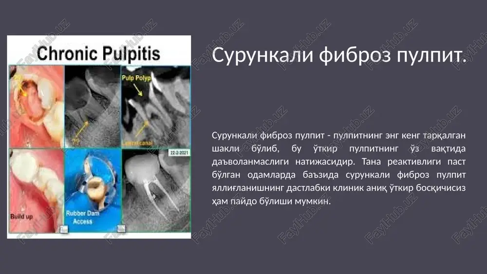 ham paydo bo'lishi mumkin; ikkinchi holda, "o'z-o'zidan" og'riq paydo bo'lishi mumkin, ammo bu simptom beqaror. issiqdan va oziq-ovqat eyilganda lvqat qoldiqlari tushganda og'riq paydo bo'lishi mumkin. tekshiruvda, ko'pincha zondlashga javob reaktsiyasi mavjud emas, bu toj pulpasining o'limini ko'rsatadi, ammo chuqur zondlash og'riqqa sabab bo'ladi. toj pulpasining nekrozi bo'lsa, u yoqimsiz hidli strukturasiz massa sifatida namoyon bo'ladi, pulpaning elektr qo'zg'aluvchanligi esa sezilarli darajada kamayadi (40-60.). tish bo'shlig'i yopiq bo'lsa, issiqqa nisbatan sinama og'riqni keltirib chiqarishi mumkin, perkussiya ba'zida zaif ijobiy reaktsiya beradi. radiologik jihatdan periodontal yoriqning kengayishi ko'pincha aniqlanadi, ba'zida suyak to'qimalarining ingichkalashi bilan. 5 surunkali pulpitning o'tkirlashuvi techenie xronicheskogo pulpita neredko xarakterizuetsya bolee ili menee tyajelimi obostreniyami, kotorie oshibochno traktuyutsya kak ostrie formi pulpita. pri ustanovlenii diagnoza vajnuyu rol igraet anamnez. obichno bolnie jaluyutsya na rezkie bolevie pristupi (paroksizm boli), poyavivshiesya posle togo, kak dlitelnoe vremya v zube oshushalis nelovkost, inogda chuvstvo tyajesti, pokalivaniya vo vremya edi, t. e. rech …