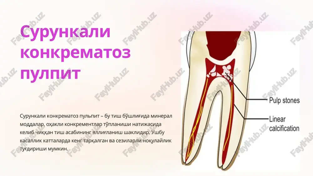 bilan pulpa obliteratsiyasini keltirib chiqaradi 5 surunkali konkrematoz pulpit bularning barchasi pulpitning himoya va regenerativ xususiyatlarining pasayishiga olib keladi, bu pulpitning turli shakllarini davolash usulini tanlashda e'tiborga olinishi kerak. konkrematozli pulpit atamasi adabiyotda va amalda kiritilgan bo'lib, unda pulpaning surunkali yallig'lanishini undagi kaltsifikatsiyani aniqlash bilan tavsiflaydi 6 pulpa kaltsifikatsiyasining klinik ko'rinishi klinik amaliyotda bemorlar zararlangan tish tojining sarg'ayishi bilan shifokorga murojaat qilishadi. ushbu rang o'zgarishi dentin implantatsiyasining intensivligi bilan bog'liq. bilishingiz kerakki, barcha tishlar rangini o'zgartirmaydi. boshqa tomondan, kulrang rang pulpa nekroziga olib keladigan travma tufayli sezilarli bo'ladi. pulpa kaltsifikatsiyasi ko'pincha tashqi tishlarda kuzatiladi va jarohatlardan uch oy o'tgach o'zini namoyon qiladi, garchi bu bir yil davomida sezilmasligi mumkin. 7 ko'pincha kaltsifikatsiyalangan pulpa bo'lgan tishlar tuk-sariq rangga ega bo'ladi, bu uchlamchi dentinxosil bulishi tufayli bo'lishi mumkin. ular pulpa bo'shlig'ining ichki tuzilishini o'zgartirishi mumkin, bu esa kirishni qiyinlashtiradi. endodontik asboblarning uchlari og'ishi yoki ularni ushlashi mumkin. 8 pulpa kaltsifikatsiyasining rentgenografik tasviri …