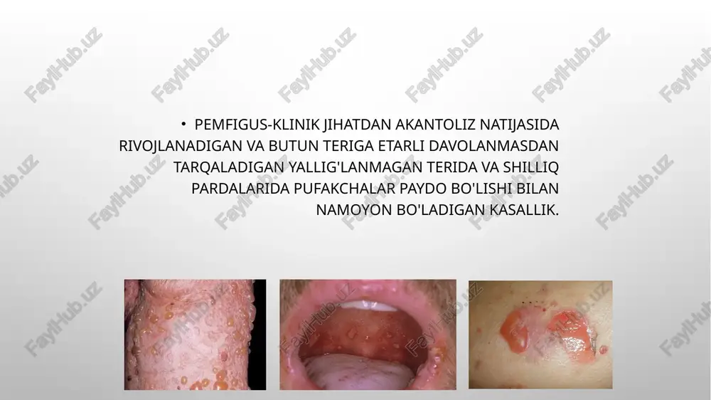 yo'q yoki juda oson olib tashlanadigan fibrinoz qoplama bilan qoplangan. döküntüler o'zgarmagan shilliq qavatda paydo bo'ladi. boshqa hollarda, pufakchalar 1-2 dan 30-40 mm gacha (yasmiq donasidan kaptar tuxumigacha) birinchi navbatda shaffof tarkibga ega, keyinchalik ular sarg'ish va bulutli soyani olishlari mumkin. pufakchalarning shinalari dastlab taranglashadi, so'ngra bo'shashib qoladi, pufakchaning ochilishi shinaning yorilishi yoki ekssudatning rezorbsiyasi natijasida yuzaga keladi (pufakchalar quriganida terida qobiqlar hosil bo'ladi, shilliq qavatida zich blyashka paydo bo'ladi). kasallikning bosqichlari kasallikning birinchi bosqichi shilliq qavatida bitta yoki bir nechta mayda pufakchalar paydo bo'lishi bilan tavsiflanadi, ular aniq umumiy faol hodisalar bilan birga bo'lmaydi. ular ochilganda eroziya hosil bo'ladi. nikolskiyning alomati har doim ham ijobiy emas. ikkinchi bosqich katta pufakchalarning rivojlanishi bilan tavsiflanadi, ular ochilganda eroziya qoladi. ular tez-tez birlashib, yorqin qizil eroziv sirt hosil qiladi. eroziya ovqatlanish paytida yoki asbob bilan tegizilganda osongina qon ketadi. til shishgan, tish izlari qayd etilgan. nikolskiyning alomati ijobiy. gipersalivatsiya, eroziyaning o'tkir og'rig'i …
