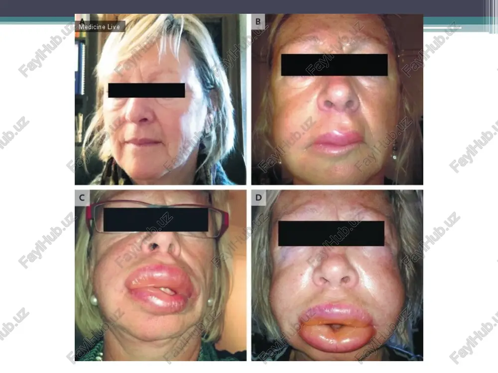 uyushix zabolevaniyax; svedeniya o razvitii nastoyashego (stavshego povodom pervichnogo obrasheniya) zabolevaniya. dannie ob'ektivnogo issledovaniya dannie vneshnego osmotra; dannie osmotra polosti rta i tablitsu sostoyaniya zubov, zapolnennuyu s ispolzovaniem ofitsialno prinyatix sokrasheniy (otsutstvuet — o, koren — r, karies — s, iskusstvenniy zub — i)i t.d.; opisanie prikusa; opisanie sostoyaniya slizistoy obolochki polosti rta, desen, alveolyarnix otrostkov i neba; dannie rentgenovskix i laboratornix issledovaniy. razvitie nastoyashego zabolevaniya ukazat poyavlenie pervix priznakov zabolevaniya, xarakter techeniya, lechenie i ego effektivnost. v kartu doljni bit vneseni rezultati laboratornix i drugix metodov issledovaniya. diagnoz zapolnyaetsya lechashim vrachom kak okonchatelniy diagnoz posle sbora anamneza, osmotra i provedeniya pri neobxodimosti dopolnitelnix metodov issledovaniya. v nekotorix sluchayax diagnoz mojet bit utochnen ili daje zamenen, no pri etom doljna bit ukazana data. odnako vo vsex sluchayax diagnoz doljen bit ukazan v sootvetstvii s sushestvuyushimi klassifikatsiyami. plan lecheniya v pervoe poseshenie bolnogo, chto pozvolyaet osushestvlyat polnoe i kompleksnoe lechenie. nalichie …