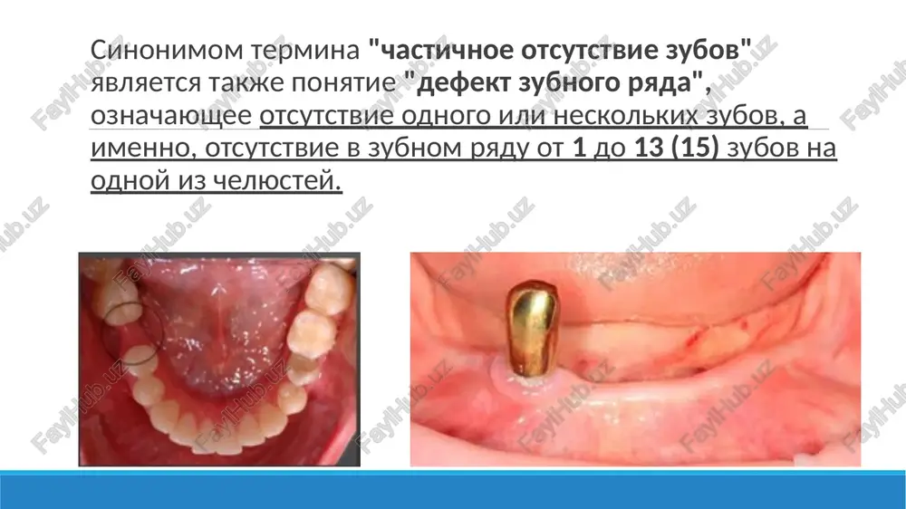 rayas na estestvennie zubi, peredaet jevatelnoe davlenie na parodont. mostovidnie protezi vosstanavlivayut effektivnost jevaniya do 100 %. klassifikatsii mostovidnix protezov • po materialu: metallicheskie, nemetallicheskie (plastmassovie, keramicheskie) i kombinirovannie ( metalloplastmassovie i metallokeramicheskie). • po xarakteru krepleniya: nes'emnie i s'emnie (malie sedlovidnie protezi) • po konstruktsii: tselnie i sostavnie. • po raspolojeniyu opornix zubov: s dvustoronney oporoy i odnostoronney - konsolnie. • po konstruktsii opornoy chasti proteza: razlichnie vidi koronok, polukoronki, vkladki, shtiftovie zubi i ix sochetanie. adgezivnie mostovidnie protezi mostovidnie protezi protivopokazani: 1). bolshie defekti, ogranichennie zubami s raznoy funktsionalnoy orientatsiey; 2). defekti, distalno ogranichennie zubom s patologicheskoy podvijnostyu; 3). defekti, ogranichennie zubami s nizkimi klinicheskimi koronkami; 4). defekti, pri kotorix zubi antagonisti imeyut vtorichnie deformatsii prikusa v vertikalnom napravlenii (znachitelnoe zuboalveolyarnoe udlinenie antagonistov v napravlenii defekta), kogda protezirovanie mostovidnim protezom nujdaetsya v predidushey spetsialnoy ortodonticheskoy ili xirurgicheskoy podgotovke; 5). nalichie patologicheskix izmeneniy periapikalnix tkaney opornix zubov (neizlechennie xronicheskiy …