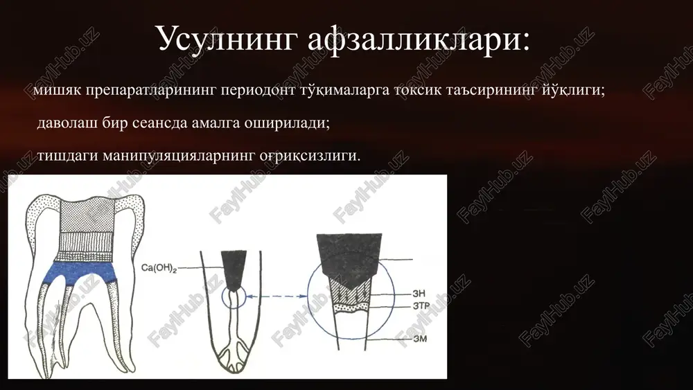 nie zubi trepaniruyutsya v tsentre yazichnoy (nebnoy) poverxnosti i perpendikulyarno prodolnoy osi zuba 5 3. vskritie pulpovoy kameri vskritie pulpovoy kameri osushestvlyaetsya sharovidnim borom №2 na nizkoy skorosti vrasheniya po kratchayshemu puti v storonu naibolee vistupayushego roga pulpi. bor sleduet derjat parallelno osi zuba. 6 4. raskritie i rasshirenie pulpovoy kameri s amputatsiey koronkovoy chasti pulpi zuba vnachale osushestvlyayutsya snyatie krishi pulpovoy kameri po perimetru i amputatsiya koronkovoy chasti pulpi. zatem dvijeniyami iznutri knaruji proizvoditsya rasshirenie pulpovoy kameri do momenta, poka karioznaya polost ne budet plavno perexodit v polost zuba. bor sleduet orientirovat parallelno prodolnoy osi zuba v sootvetstvii s ee naklonom. 7 5. ekstirpatsiya pulpi iz kornevogo kanala zuba. ekstirpatsiya pulpi osushestvlyaetsya pulpoekstraktorom sootvetstvuyushego razmera, kotoriy vvoditsya po stenke kornevogo kanala do upora (fiziologicheskogo apeksa), povorachivaetsya po chasovoy strelke na 360° i izvlekaetsya takje po stenke kornevogo kanala vmeste s sosudisto-nervnim puchkom. izvlechennaya pulpa po forme i dline sootvetstvuet …