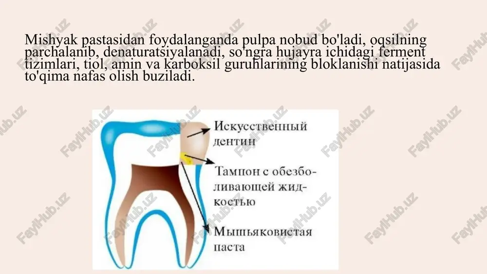 ildiz kanallariga kirishni ta'minlaydi. tish bo'shlig'ida ishlash pastki qismning teshilishiga yo'l qo'ymaslik uchun vizual nazorat ostida (oyna orqali) amalga oshirilishi kerak. borni devorlarining teshilishini oldini olish uchun tish o'qi bo'ylab qat'iy ushlab turish kerak. ildiz pulpasini ekstirpatsiya qilish tegishli diametrli pulpoekstraktor yordamida amalga oshiriladi, uni yarim burilishda devor bo'ylab ildiz kanalining butun chuqurligiga kiritadi va o'z o'qi atrofida 1-2 marta aylantirib, ildiz pulpasini o'ziga o'rab oladi. asbobni devor bo'ylab kanaldan olib chiqib, ular pulpa butunlay olib tashlanganligiga ishonch hosil qilishadi. agar pulpoekstraktor juda qattiq kirsa, edta (etilendiamintetraasetat) o'z ichiga olgan preparatlar va drilbor yordamida kanalni kengaytirish va keyin ekstirpatsiyani boshlash kerak. bu kanaldagi pulpoekstraktorni buzishining oldini oladi. kanallarni kengaytirgandan so'ng, ular 1% yodinol eritmasi, 3% natriy gipoxlorit eritmasi, 30% lizozim eritmasi, 10% dimexidum eritmasi, 3% vodorod peroksid eritmasi, 0,02% furatsilin eritmasi va boshqalar bilan tibbiy davolanadi.kanallarni dori-darmon bilan davolashda asosiy talab periodontal to'qimalarga ehtiyotkorlik bilan munosabatda bo'lishdir. pulpitni davolashning jarrohlik, …