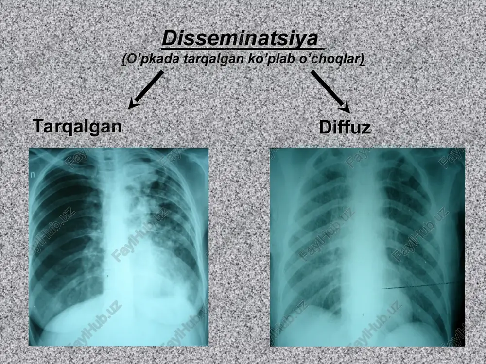 en qorayish o’chog’i (sirroz hududi ), o’pka hajmini kichrayishi bilan boradi. ko’ks oralig’i limfa tugunlari kattalashishi kuzatiladi o’pka surati kuchayishi fonida maydao’choqli soyalar . ildiz kengaygan,zichlashgan . pastki bo’laklar emfizemasi , plevradiafragmal bitishmalar . keyinchalik konglomeratli tugunlar hosil bo’ladi . yurak – lyogochnoy konfiguratsii o’pka sili disseminatsiyalangan o’pka sili – bu jarayon gemotogen,limfogen,bronxogen jarayon natija bo’lib hisoblanadi kasallik shakllari milliar . o’choqlar hajmi 0.2 sm. o’choqlar ikkala o’pkalarda ko’zgusimon tarzda joylashadi . o’pka surati ko’rinmaydi. ildizlar o’zgarmagan . mayda o’choqli. o’choqlar joylashishi assimetrik (ko’pincha yuqori bo’laklarda ), kichik kvernalar ,o’pka surati kuchaygan. yirik o’choqli . 0.6 dan 1.5 sm gacha o’choqlar . yallig’lanish belgilari yaqqol nomoyon bo’lgan . subtotal va total disseminatsiya parchalanish belgilari bilan kollagenozlar xemen-rich sindromi diffiz intersitsial fibroz , alveolalararo moddada biriktiruvchi to’qimani ko’payishi , alveolalar devoir qalinlashishi , alveolalarni to’liq oliteratsiyatsiyasigacha , mayda bronxlar va qontomirlar atrofida biriktiruvchi fibroz to’qima o’sishi . klinik kechishi hansirash kam …