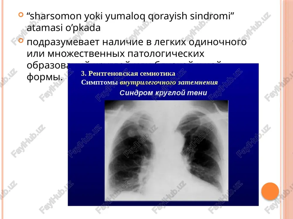 fii legkix mojno neposredstvenno izmerit plotnost tkaney, imeyushixsya v strukture gamartomi, chto pozvolit sdelat zaklyuchenie o nalichii jirovoy i xryashevoy tkani, a takje obizvestvleniy. na kt legkix gamartoma viglyadit kak subplevralno raspolojennoe obrazovanie s rovnimi krayami i chetkimi konturami, imeyushee neodnorodnuyu strukturu za schet jirovoy tkani i obizvestvleniy. gamartoma yazichkovix segmentov verxney doli levogo legkogo pri kompyuternoy tomografii, legochnoe elektronnoe okno. gamartoma levogo legkogo. skanogramma v bokovoy proektsii. vblizi grudnoy stenki vidna ten nevisokoy intensivnosti. tuberkuloma (kazeoma) legkix predstavlyaet soboy plotniy obichno okrugliy kazeozniy ochag diametrom bolee 1 sm, imeyushiy virajennuyu kapsulu. na rentgenogramme tuberkulema legkogo imeet vid okrugloy, chetko otgranichennoy teni. ten solitarnoy tuberkulemi mojet bit odnorodnoy, neodnorodnoy (s bolee plotnimi vklyucheniyami i kaltsinatami). ten konglomeratnoy tuberkulemi sostoit iz neskolkix fokusov. v okrujayushey legochnoy tkani chasto opredelyayutsya ochagi tuberkuleznogo vospaleniya, fibroz, vo vnutrigrudnix limfaticheskix uzlax - kaltsinati. tuberkuloma pri kt grudnoy kletki predstavlyaet soboy inkapsulirovannoe (imeyushee plotnuyu stenku) obrazovanie …