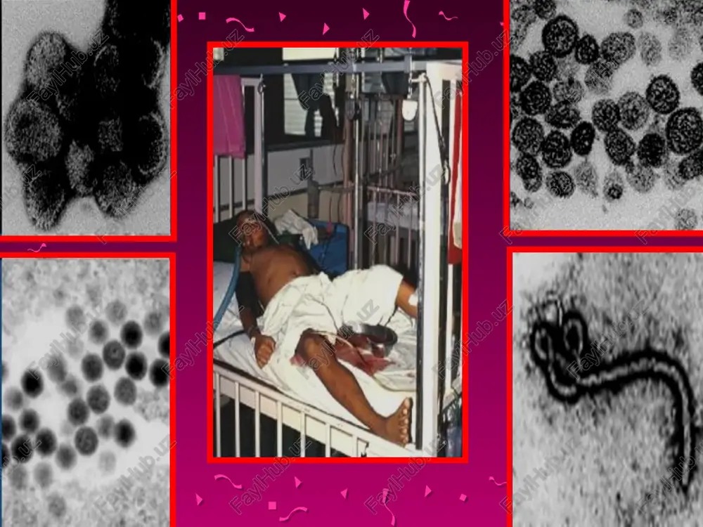 t simptomi vgi klinik ko’rinishi gemoragik konyuktivit vgi klinik ko’rinishi melena (ichakdan qon ketish) oshqozondan qon ketish shok sindromi shok sindromi gemorrogik isitmaning ogir ko’rinishida namoyon bo’ladi. qon tomirlari ichidagi umumiy hajm kamayishi plazmaning bo`shliqqa chiqishi hisobiga. yurak qon tomir patologiyasi. shok va dvs(i) dvs birinchi daraja( giperkoagulyatsiya fazasi.)siga mos keladi. shok oldi yoki shok birinchi daraja. (kompensatsiyalashgan yoki shokning gemodinamik fazasi) shok va dvs (ii) dvs(ii) darajali (turli yo’nalishdagi koagulopatiya sistemasining siljishi) shok(ii) daraja subkompentsatsiya yoki gipodinamik faza. shok va dvs(iii) dvs(iii) daraja gipokoagulyatsiya shok (iii)-(iv) daraja dekompensatsiya adinamik yoki terminal “qaytmas" faza vgi da plazma yo`qotish kreteriylari suyuqlik to’planishi tadr va gemorrogik isitma kirim kongo gemorrogik isimtmasi. gemorrogik isitma buyrak sindromi bilan. gemorrogik isimtma buyrak sindromi bilan bun'yaviruslar ,xantaviruslar xech bo’lmaganda glps chaqiruvchi 5 ta virus . tarqalish va o`choqlanish xususiyatiga ega bsgi o`rganilish tarixi. vssh koreys urush vaktlarida 3000 soldat gi ning engil turi bilan kasallangan 10-15% …