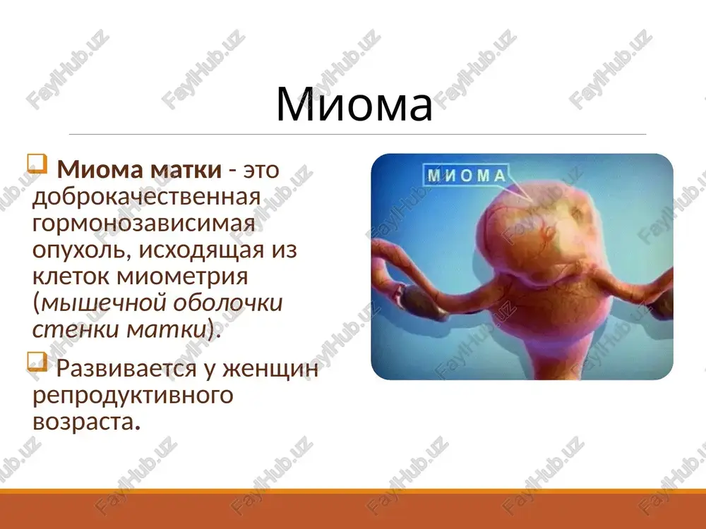 vnya estestvennix killerov; snijenie urovnya t-limfotsitov; povishenie urovnya perefericheskix t-xelperov; tyajest immunnix narusheniy korreliruet s kolichestvom miomatoznix uzlov; pri povishenii kolichestva miomatoznix uzlov, snijaetsya uroven v-limfotsitov preobladayut protsessi aktivatsii vrojdennogo i gumoralnogo immuniteta na fone usileniya immunosupressivnogo komponenta faktori riska snijenie riska: 1.priem kok 2.fizicheskaya aktivnost 3.kurenie 4.bolee 3 rodov v anamneze povishenie riska: 1.ranneemenarxe 2.otsutstvie rodov v anamneze 3.pozdniy reproduktivniy vozrast 4.ojirenie 5.alkogol tri stadii razvitiya miomi matki: obrazovanie aktivnoy zoni rosta v miometrii v vide perivaskulyarnix muft s usilennoy proliferatsiey gladkomishechnix kletok s aktivirovannim kletochnim metabolizmom. rost opuxoli bez priznakov differentsirovki. rost opuxoli s differentsirovkoy, sozrevaniem i postepennim fibrozirovaniem . klassifikatsiya vidi miomatoznix uzlov: subseroznaya – rastet v storonu bryushnoy polosti (podbryushinnaya); submukoznaya – mioma rastet v storonu polosti matki (podslizistaya); interstitsialnaya – mejmishechnaya mioma matki (intramuralnaya); intraligamentarnaya – mejsvyazochnaya mioma matki klassifikatsiya miom (figo, 2011) klinicheskie proyavleniya menorragii, menometrorragii; bolevoy sindrom; narushenie funktsiy sosednix organov; nevinashivanie beremennosti; …