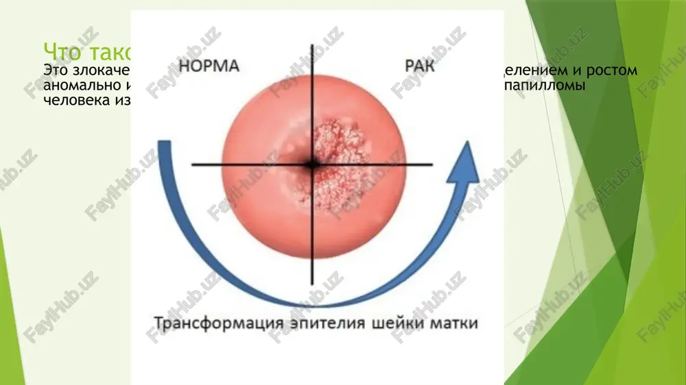 lnix limfouzlax, ix razmeri m – nalichie (otsutstvie) metastazov v otdalennix limfouzlax i vo vnutrennix organax klinicheskaya kartina pri mikroinvazivnom rake kontaktnie krovyanistie videleniya posle polovogo akta, palpatornogo issledovaniya sheyki matki, sprintsevaniy, osmotra v zerkalax. pri dalneyshem razvitii invazii uvelichivaetsya skorost rosta opuxoli. nachinaetsya mestno-regionarnoe rasprostranenie v svyazki sheyki matki, vlagalishe, telo matki, v limfouzli, a v daleko zashedshix sluchayax – v mochevoy puzir i pryamuyu kishku. dlya etogo etapa tipichni obilnie krovyanistie videleniya, beli (limforeya) i boli, kotorie vnachale lokalizuyutsya v sheyke matki, a zatem pri rasprostranenii opuxoli v parametralnuyu kletchatku i stenki malogo taza – irradiiruyut v krestets, poyasnitsu, tazobedrennie sustavi. diagnostika dvuxetapnaya sistema diagnostiki: 1. skrinig – pervichnoe viyavlenie 2. uglublennaya diagnostika – pri podozrenii na predrak ili rak skrining tsel skrininga: 1) opredelenie grupp riska razvitiya raka sheyki matki 2) viyavlenie kontingenta jenshin s predrakovoy patologiey sheyki matki 3) napravlenie jenshin dlya vtorogo etapa uglublennogo issledovaniya …