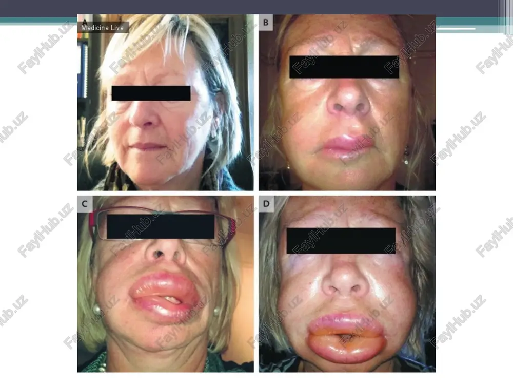 niya); professiyu; diagnoz pri pervichnom obrashenii; svedeniya o perenesennix i soputstvuyushix zabolevaniyax; svedeniya o razvitii nastoyashego (stavshego povodom pervichnogo obrasheniya) zabolevaniya. dannie ob'ektivnogo issledovaniya dannie vneshnego osmotra; dannie osmotra polosti rta i tablitsu sostoyaniya zubov, zapolnennuyu s ispolzovaniem ofitsialno prinyatix sokrasheniy (otsutstvuet — o, koren — r, karies — s, iskusstvenniy zub — i)i t.d.; opisanie prikusa; opisanie sostoyaniya slizistoy obolochki polosti rta, desen, alveolyarnix otrostkov i neba; dannie rentgenovskix i laboratornix issledovaniy. razvitie nastoyashego zabolevaniya ukazat poyavlenie pervix priznakov zabolevaniya, xarakter techeniya, lechenie i ego effektivnost. v kartu doljni bit vneseni rezultati laboratornix i drugix metodov issledovaniya. diagnoz zapolnyaetsya lechashim vrachom kak okonchatelniy diagnoz posle sbora anamneza, osmotra i provedeniya pri neobxodimosti dopolnitelnix metodov issledovaniya. v nekotorix sluchayax diagnoz mojet bit utochnen ili daje zamenen, no pri etom doljna bit ukazana data. odnako vo vsex sluchayax diagnoz doljen bit ukazan v sootvetstvii s sushestvuyushimi klassifikatsiyami. plan lecheniya v pervoe …