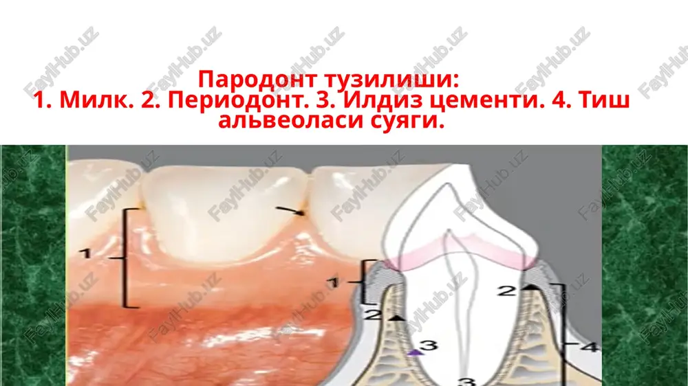 ydi ½ og'ir darajasi – tish balandligining yarmidan ko'pini qopladi. milk atrofiyasi. milk atrofiyasi-milk to'qimasini hajmida kamayishi bilan kechadi, milk qirg'og'ini apikal tarafga qarab joylashib, patologik tish-milk cho'ntagini hosil qlmaydi. milkdagi parodont jarrohatlanishining elnmntlari. epulis – 1.3 tish sohasida havfsiz odotogen o'simta. 5.1. va 6.1. tish sohasida periodontit natijasida hosil bo'lgan oqma yo'llar. zondlash uslubi. parodontal cho'ntaklar chuqurligini o'lchash. qonashini aniqlash. milk retsessiyasini aniqlash. birikkan milk kengligini aniqlash. tishlarning qimirlash darajasini aniqlash. pokazateli indeksa gigieni polosti rta. kriterii voz. parodontitning engil darajasida parodontal cho'ntakning chuqurligi 3–5mm. ga etadi, ular asosan tishlar oralig'ida joylashadi, tishlarning qimirlashi kuzatilmaydi, indutsirlangan qonash holatlari aniqlanishi mumkin. bemorning umumiy ahvoli esa o'zgarmaydi. rentgenologik tekshiruvlarda – alveolalararo to'siqlar qirralarining uchida dog'li osteoporoz ko'rinishidagi o'choqlar aniqlanadi. alveolalararo to'siq qirralarining balandligi pasayadi (suyak to'qimasi destruktsiyasining boshlang'ich bosqichi) va ularning chegaralari noto'g'ri hamda noaniq shaklga o'tadi. parodontitning o'rta darajasida cho'ntaklar chuqurligi 5mm. ga etadi (ba'zan yiringli ajralmalar ham kuzatilishi mumkin). …
