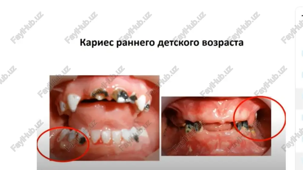 atriy, tsink, strontsiy, brom, med, marganets, volfram, tsink, alyuminiy, jelezo, ftor. kristallicheskie veshestva sostavlyayut bolee 2/3 neorganicheskogo komponenta, 4 glavnie kristallicheskie formi kotorix - apatiti: gidroksiapatit, magnieviy apatit, brushit, oktakaltsiya fosfat po strukturnim priznakam tverdie zubnie otlojeniya razdeleni na tri osnovnie gruppi: • kristallicheski-zernistie; • kontsentricheski-skorlupovatie; • kollomorfnie. organicheskiy komponent zubnogo kamnya - proteinpolisaxaridniy kompleks, sostoyashiy izslushennogo epiteliya, leykotsitov i razlichnix mikroorganizmov. uglevodi: galaktoza, glyukoza, gialuronovaya kislota, galaktozamini, reje arabinoza, galakturonovaya kislota i glikozamini - sostavlyayut okolo 10% organicheskoy fazi; proteini slyuni - 5,9-8,2%, imeyutsya neytralnie jiri, jirnie kisloti, xolesterol i fosfolipidi. po strukture zubnoy kamen - mineralizovannaya zubnaya blyashka. v svejem zubnom nalete otsutstvuyut kristalli apatita. priznaki mineralizatsii nablyudayut v nem cherez 38 ch posle nachala formirovaniya. protsess formirovaniya zubnix otlojeniy sostoit iz 3 stadiy: • i stadiya - nakoplenie mineralnix komponentov (45-60 dney) i nachalniy rost zarodivshixsya kristallov; • ii stadiya - rost i sovershenstvovanie kristallov (ot 45-60 …