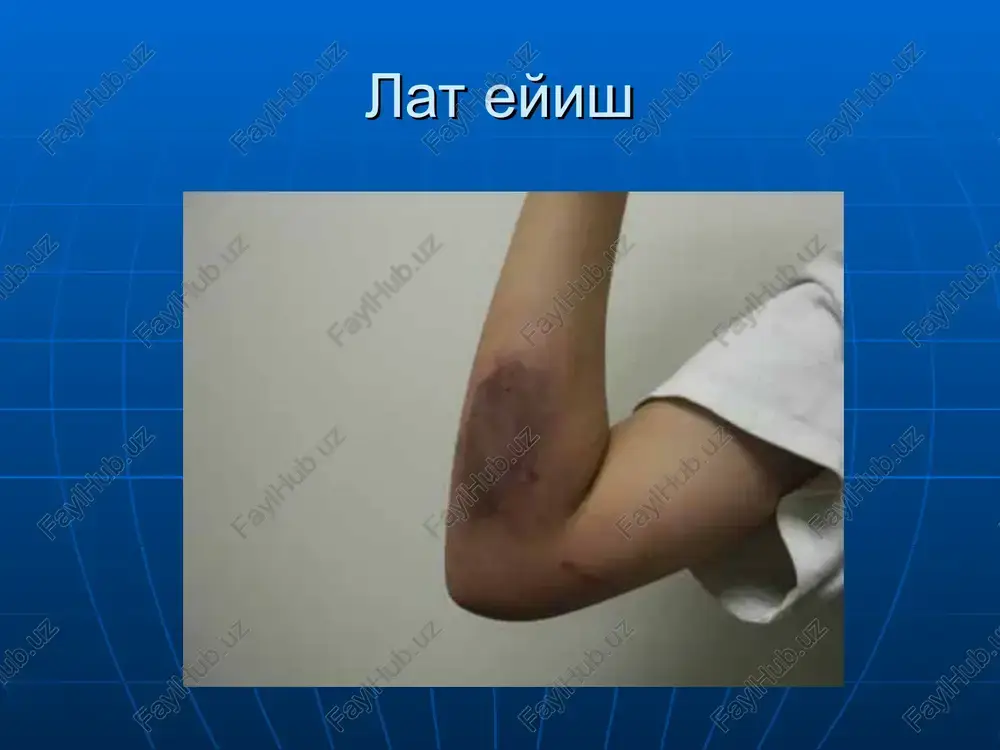 bo'ladi o'qlar o'z yo'nalishini o'zgartirishi mumkin bemor axvoli xamisha juda og'ir bo'ladi patsientni darxol gospital operatsiya xonasiga joylashtirish zarur. umurtqa jaroxati xamma vaqt bor deb xisoblash kerak avtomobil xalokatlarida piyodani avtobil urib yuborganda yukoridan pastga qulaganda bosh, buyin, ko'krak qafasi jaroxatlarida mototsikl avariyalarida osish xolatlarida (suitsid yoki kriminal) suvga sho'ng'ish bilan bog'liq xolatlarda bemor bexush xolatda, anamnezini yig'ish imkoniyati yo'q respondentlarga darxol bosh va buyinni qo'l bilan fiksatsiya qilishga kirishish zarur respondentlar bo'yin umurtqasi fiksatsiyasini davom ettirgan xolda bo'yin fiksatorini o'rnatishadi respondent #1 bemorni beltaxtaga o'tkazish #1 respondent – brigada ishini boshqaradi “xisob, 1-2-3 ” bo'yin umurtqasini qo'l yordamida fiksatsiya qilish respondentlar bemor boshi va bo'ynini fiksatsiya qilishdi tashqi qon ketishi juda kuchli bo'lishi mumkin - tezda shok xolatiga keltirishi mumkin! kattalar: 1000 ml bolalar: 500 ml chaqaloklar: 150 ml juda kerakli: patsient belgi va simptomlari! tashqi qon ketishi organizm ximoya mexanizmlari: - vazokonstriktsiya - tromb xosil bulishi katta tomirlardan …