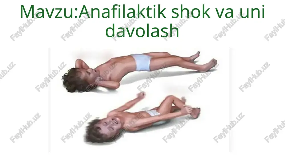 xushdan ketgan bo‘ladi. o‘tkir tserebral gipoksiya sababli epileptik xurujlar ro‘y beradi. bunday paytlarda bemor o‘lib qolishi mumkin. biroz engil holatlarda engil bronxospazm, sinkope va teriga o‘tib ketuvchi toshmalar toshadi. adrenalinning 0,1 % li 0,3-0,5 ml eritmasi teri ostiga qilinadi (og‘ir holatlarda v/i ga yuboriladi). farmakokinetikasi mushak ichiga yoki teri ostiga yuborilganida tez so‘riladi; qonda smax 3-10 minutdan keyin erishiladi. yo‘ldosh to‘sig‘i orqali, ko‘krak sutiga o‘tadi, gematoentsefalik to‘siq orqali o‘tmaydi. vena ichiga yuborilganda t1/2 1-2 minutni tashkil qiladi. metabolitlarining chiqarilishi buyrak orqali amalga oshiriladi. qo‘llanilishi -darhol rivojlanadigan allergik reaktsiyalar dori vositalari, zardoblar qo‘llanganida, qon quyishda, hashorotlar chaqqanida yoki allergenlar bilan muloqatda rivojlanadigan anafilaktik shok. –bronxial astma – xurujni bartaraf etish uchun.turli genezli arterial gipotenziya (postgemorragik, intoksikatsion, infektsion).insulinning dozasini oshirib yuborilishi oqibatidagi gipoglikemiya.asistoliya, yurakni to‘xtab qolishi.mahalliy anestetiklarning ta’sirini uzaytirish qo‘llash mumkin bo‘lmagan holatlar preparatning komponentlariga yuqori sezuvchanlik; gipertrofik obstruktiv kardiomiopatiya, og‘ir aortal stenoz, taxiaritmiya, qorinchalar fibrillyatsiyasi, feoxromotsitoma, yopiq burchakli glaukoma, shok (anafilaktik …
