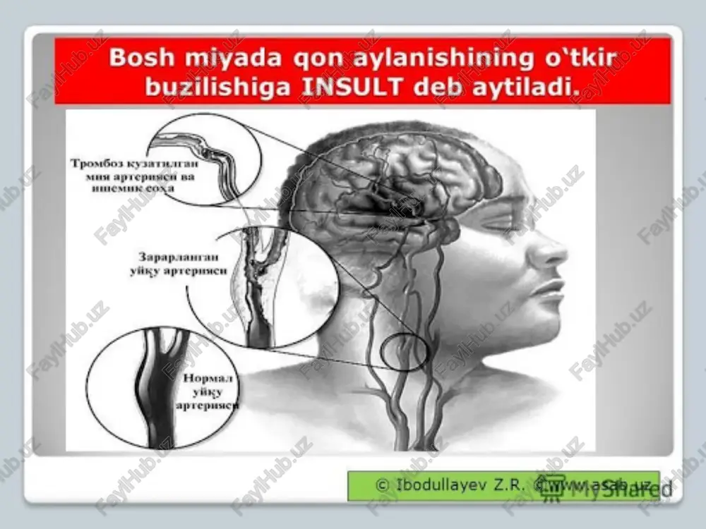 pulsi tarang va siyraklashgan bo’ladi, harorati ko’tariladi, siydik va najasi kel- may qoladi yoki beixtiyor chiqib ketadi. hayot uchun xavfli bu holat 1—3 kun davom etib, keyin bemor hushiga keladi va miyaning biror sohasi zararlanganligini ko’rsatuvchi belgilar yuzaga chiqadi; ko’pincha gavdaning o’ng yoki chap qismi falaj bo’ladi (gemiplegiya), bemor tildan qoladi yoki tuzuk gapira olmaydi. bir necha oydan keyin falaj deyarli barham topishi, bemor yana tilga kirishi mumkin. ishemik insult ishemik insult miya tomirlarining trombozi natijasida paydo bo’ladi, bu miya to’qimasining yumshashi — miya infarktiga sabab bo’ladi. bosh og’rishi, aylanishi kabi dastlabki belgilar paydo bo’lgandan keyin bemor hushdan ketmay, qo’l yoki oyoq uvishadi, so’ngra parez yoki falaj bo’ladi, sezish qobiliyati yo’qoladi yoki pasayadi, nutq buziladi. bemorning rangi o’chgan, ko’z qorachiqlari tor, pulsi zaif, ammo harorati normal bo’ladi. buzilgan funksiyalar bir necha oyda asliga kelishi mumkin. ishemik insultning asosiy sababi miya tomirlarining aterosklerozidir. xastalik keksa yoshlilar, ko‘pincha yurak kasalliklari va qon …