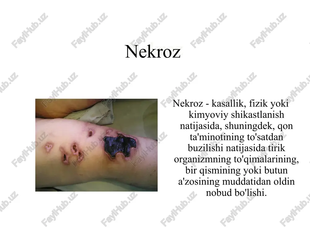 lashuvi: nekrektomiya amputatsiya yaralar ulkus nekroz shakllaridan biri bo'lib, nekrozni rad etish natijasida rivojlanadigan va regeneratsiya jarayonlarining etarli emasligi sababli surunkali holatga o'tadigan integument va pastki to'qimalarning nuqsonidir. yaralarning sabablari qon aylanishi va limfa aylanishining buzilishi neyrotrofik kasalliklar to'qimalarning shikastlanishi infektsion va yallig'lanish to'qimalarining o'zgarishi metabolik kasalliklar haddan tashqari dori terapiyasi davolash yotoq yara dekubitus - uzoq muddatli mexanik bosim natijasida kelib chiqqan ishemiya natijasida yuzaga keladigan yumshoq to'qimalarning nekrozi tasnifi endogen yoki nevrotik trofikalarning buzilishi natijasida ekzogen - uzoq muddatli mexanik bosim ta'sirida yoki tananing umumiy holatidagi buzilishlar uning rivojlanishiga hissa qo'shganda paydo bo'ladi. (charchoq, gipoproteinemiya, vitamin etishmasligi, mikrosirkulyatsiyaning buzilishi) lokalizatsiya prolejney yotoq yara i d terining yon atrofga joylariga tarqalmaydigan eritema. shikastlanish yara paydo bo'lishidan oldin sodir bo'ladi. ii darajasi uning ostida joylashgan to'qimalarning shikastlanishi yoki nekrozi tufayli terining qalinligining qisman qisqarishi iii darajasi uning ostida joylashgan to'qimalarning shikastlanishi yoki nekrozi tufayli terining qalinligining to'liq yo'qolishi, lekin fastsiyadan …