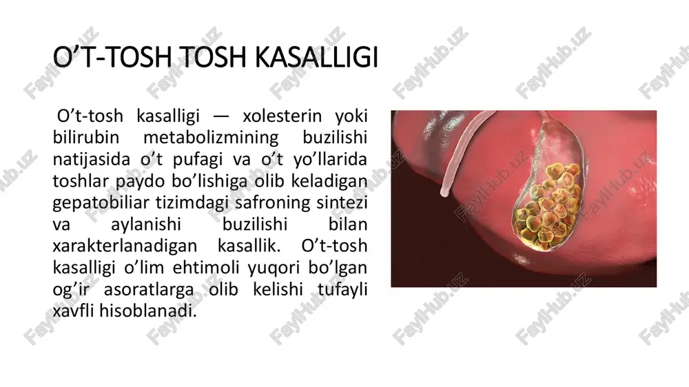lan yallig’lanish, strikturalar). funktsional buzilishlar o’t pufagi motorikasi va safro yo’llari buzilishlari (gipokinetik tipdagi safro yo’llarining diskineziyasi) bilan bog’liqdir. xolesterinning ko’payishi ortiqcha xolesterin quyidagi omillar tufayli hosil bo’ladi: • semizlik va ko’p miqdorda xolesterin saqlovchi mahsulotlarni iste’mol qilish; • safroga safro kislotalari tushishining kamayishi (estrogeniyada sekretsiyani pasayishi, o’t pufagida depolanishi, gepatotsitlarning funktsional yetishmovchiligi); • safro kislotalari kabi xolesterin va bilirubinga qotish va cho’kishga imkon bermaydigan fosfolipidlar miqdorining kamayishi; • safro aylanish tizimidagi turg’unliklar (o’t pufagidagi suv va safro kislotalarini so’rilishi natijasida safroning quyuqlashishi). o’t toshlari turlari o’t toshlari o’lchami, shakli, miqdori (bitta toshdan yuztagacha) bo’yicha turlicha bo’lishi mumkin, ammo ular asosiy tarkibiy qismlariga ko’ra xolesterinli va pigmentli (bilirubinli) toshlarga bo’linadi. sariq rangli o’t toshlari turli xil aralashmalar (minerallar, bilirubin) bilan erimagan xolesterindan iborat. toshlarning aksariyat qismi (80%) xolesterinli kelib chiqishga ega. to’q-jigarrang, qora rangli pigmentli toshlar safroda bilirubinning ko’p miqdorda bo’lishida shakllanadi, bu jigarning funktsional buzilishlari, tez-tez gemoliz, safro yo’llarining …