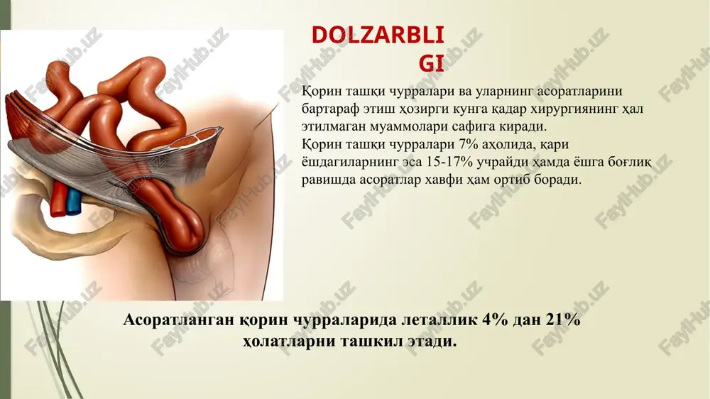 churraning to‘g‘rilanmay qolishi, churra bo‘rtmasida keskin og‘riq, uning taranglashishi va zichlashishi, “yo‘tal turtki” belgisining aniqlanmasligi – (manfiy). qisilgan churra belgilari: xar qanday churra qisilishining klassik klinik belgilari odatda uchta simptom hisoblanadi: a) churra bo'rtmasi bo'lgan joyda yoki umuman qorinda to'satdan og'riq boshlanishi; b) churra bo'rtmasi hajmining tez kattalashuvi; v) churrani to'g'rilash imkoniyatining birdaniga yo'qolishi. bu simptomlarning yuzaga chiqish darajasi har xil bo'ladi. 7 qisilgan churra bilan bemorlar xirurgiya bo’limiga yotqizilishi shart qisilgan churrada operatsiya bosqichlari aponevrozgacha to‘qimalarni qavatma-qavat kesib churra qopini ajratish, churra qopini ochish, churra suvlarini olib tashlab, qisilgan a'zoni ushlab turish, qisib turgan xalqa (churra darvozasi)ni kengaytirish, qisilgan a'zoning hayotga loyiqligini aniq-lash, hayotga noloyiq a'zo rezeksiyasi, churra darvozasi plastikasi qisilgan churra bilan bemorlarni davolashning birdan-bir to'g'ri usuli shoshilinch operatsiya. qisilgan churrani operatsiyasiz, qo'lda to'g'rilashga urinish mumkin emas. aponevrozgacha to'qimalarni qavatma-qavat kesib churra qopini ajratish, churra qopini ochish, churra suvlarini olib tashlash, qisilgan a'zoni ushlab turish, qisib turgan xalqani, …