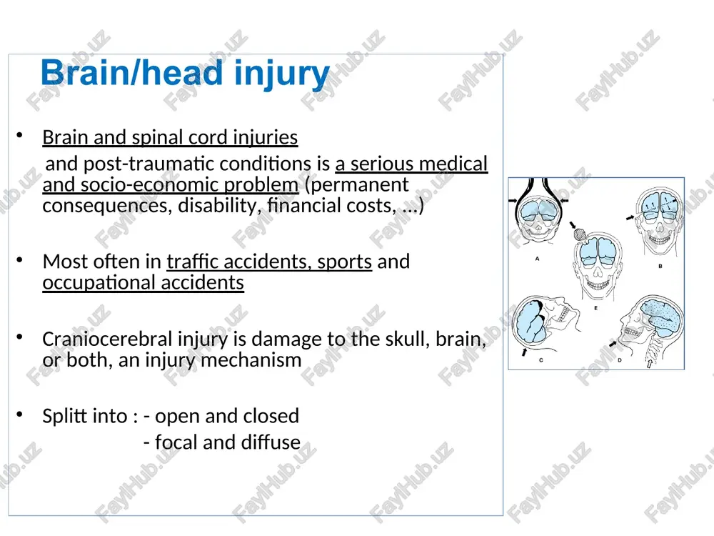 lamus, brain stem and cranial nerves injury indirectly after an injury to the vault or face bones „eyeglasses-like“ hematoma processus mastoideus ecchymosis – battle sign risks/complications: neuroinfection (purulent meningitis, brain abscess), csf fistula, ic hypotension syndrome (cfs), n. i and n.ii. injury, deafness, n.vii. damage csf - cerebrospinal fluid skull fractures - diagnosis - clinical physical evaluation- palpation - local pain, edema, or decline - skull x-ray or brain/skull ct (bone window) - liquorrhea nasalis (csf leakage through broken meninges) - otorrhea skull fractures- therapy linear skull fractures (fissurae calvae) mostly without clinical symptoms and requiring no surgical treatment observation to exclude the development of extracerebral hematoma impressive skull fractures with significant bone dislocation surgical repositioning of debris under great impression - rupture of the dura and brain contusion on the brain surface with expansive character in the frontal area - even less impression is elevated in a case when …