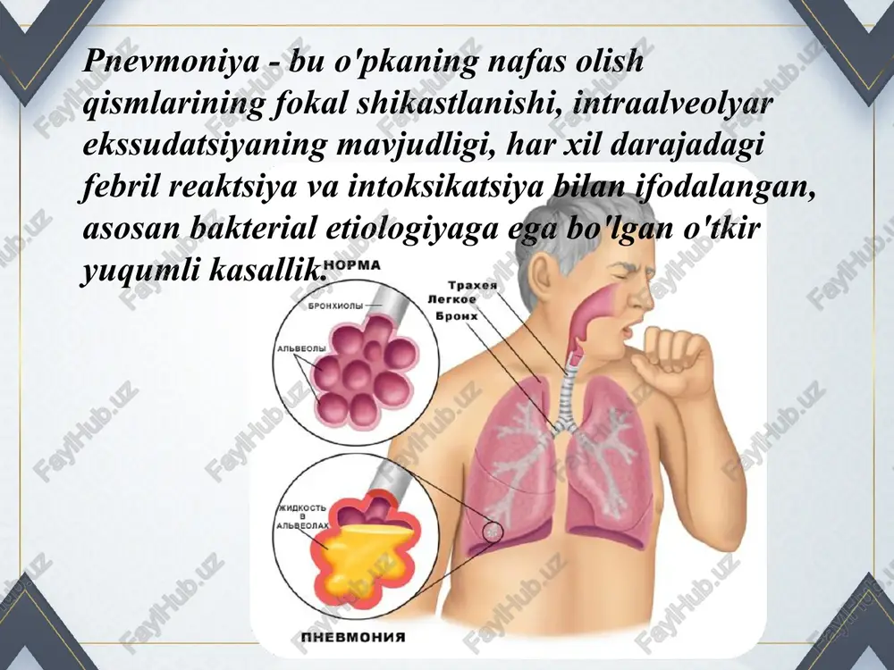 ntal segmental lobar bir tomonlama ikki tomonlama pleuropnevmoniya segmentarnoe stroenie legkix. perednyaya i zadnyaya proektsii segmentarnoe stroenie legkix. bokovie proektsii. iv. kasallik paytida 1. o'tkir - 4 haftagacha 2. cho'zilgan klassifikatsiya pnevmoniy pnevmoniyaning uzoq davom etishining sabablari: nafas olish yo'llarining mahalliy obstruktsiyasi (saraton, adenoma, mukoid blokadasi va boshqalar) bronxoektaz kistik fibroz immunitetning pasayishi rivojlanayotgan o'pka xo'ppozi takroriy intilish yashirin sil infektsiyasini faollashtirish noto'g'ri antibiotik terapiyasi klassifikatsiya pnevmoniy v. kechishi bo'yicha yengil - 38 ° s dan past bh daqiqada 20 dan kam yurak urishi = 1 ° s da daqiqada +10 urish leykotsitlar 10 000 dan kam o'rtacha og'ir t - 39 ° s dan yuqori bh daqiqada 30 dan ortiq yurak urish tezligi 120 / min dan oshadi va t bilan bog'liq emas oliguriya arterial gipotenziya 100/60 mm hg dan past leykotsitoz 25000 dan ortiq yoki 4000 dan kam 9 9 9 pnevmoniya sabablari makroorganizmlarning himoya kuchlarining samaradorligini pasayishi …