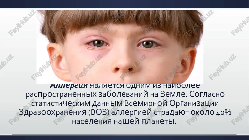 heskaya kartina anafilakticheskogo shoka xarakterizuetsya bistrotoy razvitiya - cherez neskolko sekund ili minut posle kontakta s allergenom. otmechaetsya ugnetenie soznaniya, padenie arterialnogo davleniya, poyavlyayutsya sudorogi, neproizvolnoe mocheispuskanie. molnienosnoe techenie anafilakticheskogo shoka zakanchivaetsya letalnim isxodom. neotlojnaya pomosh: pri maleyshem podozrenii na razvitie anafilakticheskogo shoka, sleduet nezamedlitelno vizivat skoruyu pomosh. do priezda vracha nujno postaratsya prekratit dalneyshee postuplenie allergena v organizm. esli anafilakticheskiy shok sluchilsya vsledstvie ukusa nasekomogo, sleduet nalojit jgut vishe mesta ukusa. takim obrazom, vi prekratite postuplenie allergena v obshiy krovotok. postaraytes pridat postradavshemu gorizontalnoe polojenie na spine s naklonennoy na bok golovoy, dlya preduprejdeniya asfiksii vsledstvie zapadeniya yazika ili aspiratsii rvotnix mass. dalee osvobojdayut sheyu, grudnuyu kletku, jivot, obespechivayut pritok kisloroda. bronxialnaya astma — xronicheskoe vospalitelnoe zabolevanie dixatelnix putey s uchastiem raznoobraznix kletochnix elementov. osnovnoe proyavlenie bronxialnoy astmi - pristup udushya so slishimimi na rasstoyanii suximi xripami. neotlojnaya pomosh: prekrashenie kontakta s allergenom. posadit bolnogo na stul, v kreslo, …