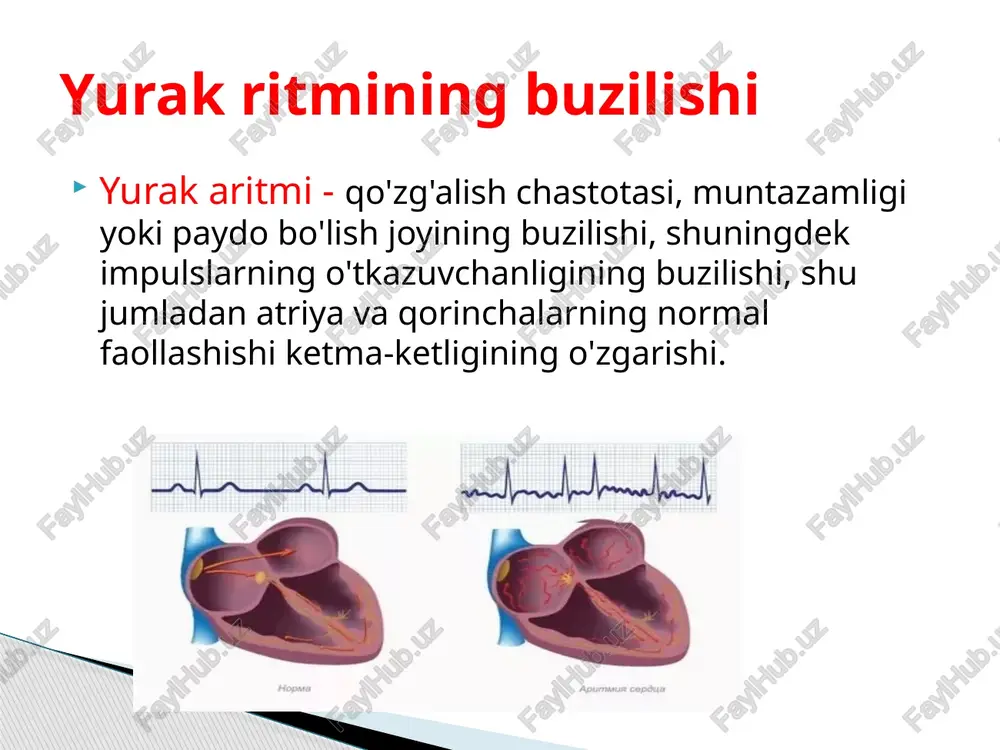 ayta kirish mexanizmi - diastolik interval bo'lmaganda to'qimalarning takroriy qo'zg'alishi bilan o'tkazuvchanlik aylanishi. qayta kirish 1. ikki potentsial yo'l; 2. yo'llardan birida yuzaga keladigan bir tomonlama blok ; 3. muqobil yo'l orqali bir yo'nalishli o'tkazuvchanlik blokining zonasi bo'ylab tarqaladigan qo'zg'alish to'lqini; 4. kechikish bilan (ya'ni, sekin o'tkazuvchanlik bilan) bir tomonlama blokirovka zonasiga distal miyokardning keyingi qo'zg'alishi; 4.qo'zg'alish to'lqinining bloklangan hududga retrograd kirishi va u dastlab paydo bo'lgan to'qimalarning qayta qo'zg'alishi. qayta kirishning yuzaga kelishi uchun bir qator shartlar zarur : diagrammada joylashgan chap (i), puls sifatida ko'rsatilgan ikkala shoxchadan erkin o'tadi (a va b.) supero'tkazuvchilar tizimning tolalari yurak (purkinje). o'rta diagrammada (ii) impulsning o'tishini ko'rish mumkin minorada a bloklangan va u faqat b shoxchasi bo'ylab o'tadi . a shoxchasi bo'ylab impulsning qaytishi bo'lishi mumkin emas refrakterligi tufayli amalga oshiriladi proksimal bloklangan uchastka . shaklda. 123, iii bloklangan sohada va unga proksimalda refrakterlik vaqtining qisqarishi tufayli a shoxobchasi orqali impulsning qaytishi …